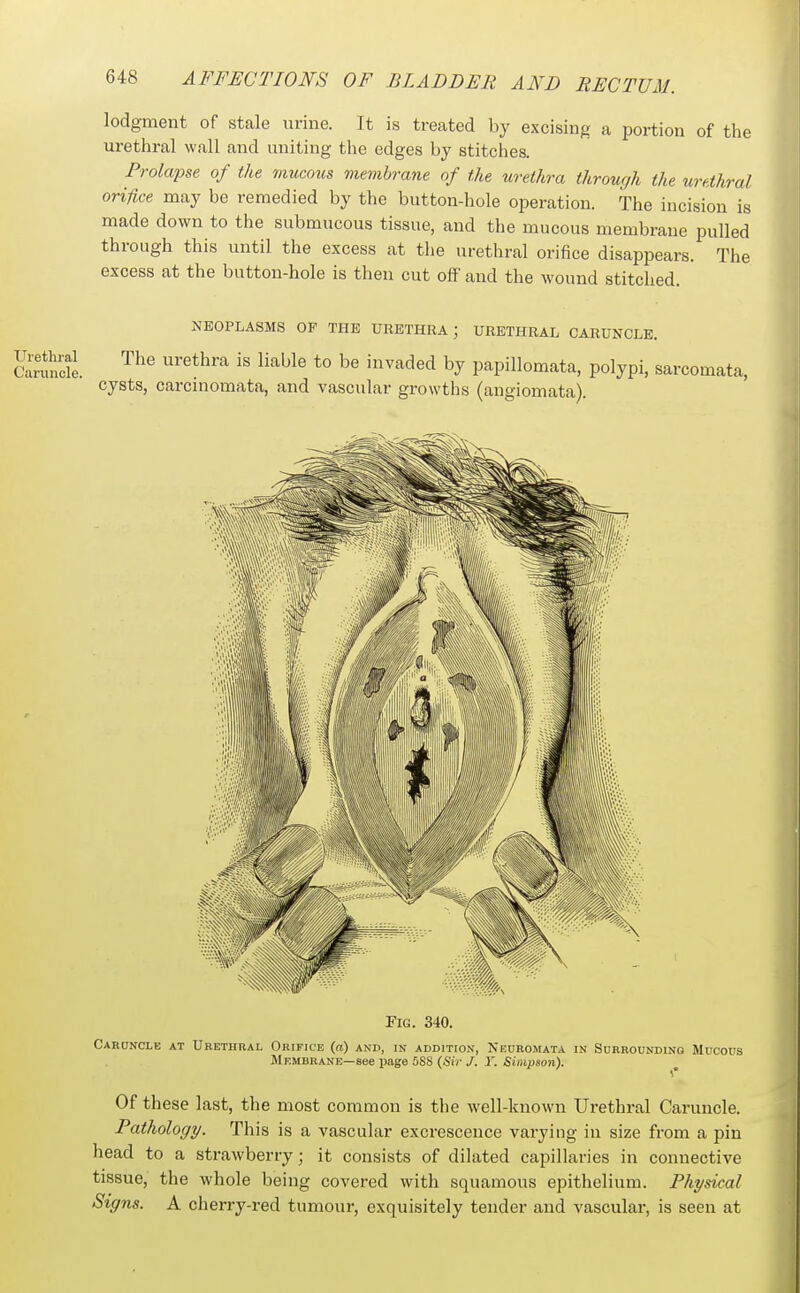 lodgment of stale urine. It is treated by excising a portion of the urethral wall and uniting the edges by stitches. Prolapse of the mucotis vietnbrane of the urethra throuqh the urethral orifice may be remedied by the button-hole operation. The incision is made down to the submucous tissue, and the mucous membrane pulled through this until the excess at the urethral orifice disappears. The excess at the button-hole is then cut off and the wound stitched. NEOPLASMS OF THE URETHRA ; URETHRAL CARUNCLE. The urethra is liable to be invaded by papillomata, polypi, sarcomata, cysts, carcinomata, and vascular growths (angiomata). Fig. 340. Cardncle at Urethral Orifice (a) and, in addition, Nedromata in Sdrroundino Mucous Membrane—see page 5S8(S!V/. r. Stjuijson). Of these last, the most common is the well-known Urethral Caruncle. Pathology. This is a vascular excrescence varying in size from a pin head to a strawberry; it consists of dilated capillaries in connective tissue, the whole being covered with squamous epithelium. Physical Signs. A cherry-red tumour, exquisitely tender and vascular, is seen at