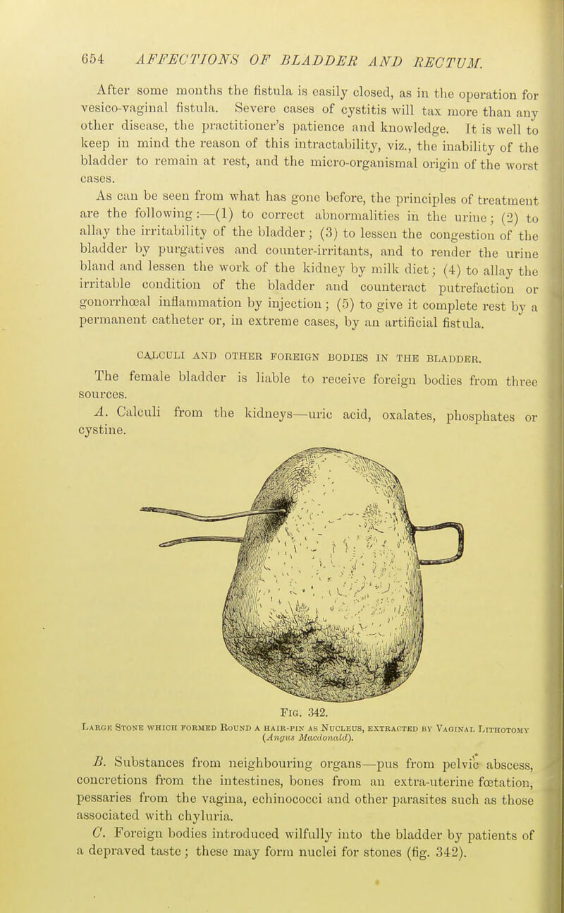 After some months the fistula is easily closed, as in tlie operation for vesico-vaginal fistula. Severe cases of cystitis will tax more than any other disease, the practitioner's patience and knowledge. It is well to keep in mind the reason of this intractability, viz., the inability of the bladder to remain at rest, and the micro-organismal origin of the worst cases. As can be seen from what has gone before, the principles of treatment are the following:—(1) to correct abnormalities in the urine; (2) to allay the irritability of the bladder; (3) to lessen the congestion of the bladder by purgatives and counter-irritants, and to render the urine bland and lessen the work of the kidney by milk diet; (4) to allay the irritable condition of the bladder and counteract putrefaction or gonorrhoea! inflammation by injection ; (-5) to give it complete rest by a permanent catheter or, in extreme cases, by an artificial fistula. CALCOLI AND OTHER FOREIGN BODIES IN THE BLADDER. The female bladder is liable to receive foreign bodies from three sources. A. Calculi from the kidneys—uric acid, oxalates, phosphates or cystine. Fig. 342. Large Stone which formed Round a uaib-pik as Ndcleos, extracted by Vaginal Lithotomy {Angus Macdonald). B. Substances from neighbouring organs—pus from pelvic abscess, concretions from the intestines, bones from an extra-uterine foetation, pessaries from the vagina, ecliinococci and other parasites such as those associated with chyluria. C. Foreign bodies introduced wilfully into the bladder by patients of a depraved taste ; these may form nuclei for stones (fig. 342).