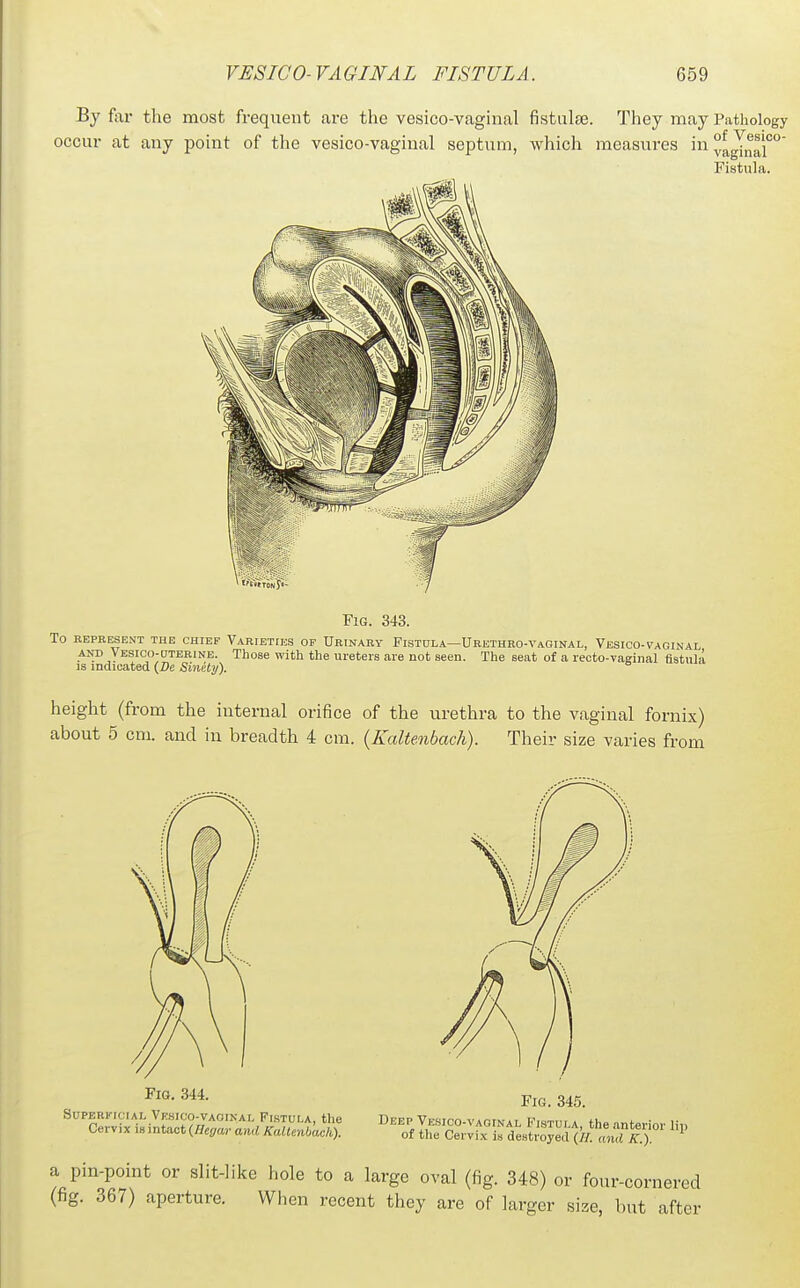 By far the most frequent are the vesico-vaginal fistulse. They may Pathology occur at any point of the vesico-vaginal septum, which measui-es in°^J®^P' Fistula. Fig. 343. To REPRESENT THE CHIEF VARIETIES OF UrINARY FISTULA—URETHRO-VaGINAL, VeSICO-VAOINAL AND Vesico-uterine. Those with the ureters are not seen. The seat of a reoto-vasinal fistula IS indicated {De SinHy). height (from the internal orifice of the urethra to the vaginal fornix) about 5 cm. and in breadth 4 cm. {Kaltenbach). Their size varies from Fia. 344. SUPBRKICIAL Vesico-vaoinal Fistui.a, the Cervix is intact {Hegar and Kaltenbach). Fig. 345. Deep Vesico-vaqinal I'^istui.a, the anterior liu of tlie Cervix is destroyed (//. and K.). a pin-point or slit-like hole to a large oval (fig. 348) or four-cornered (fig. 367) aperture. When recent they are of larger size, but after