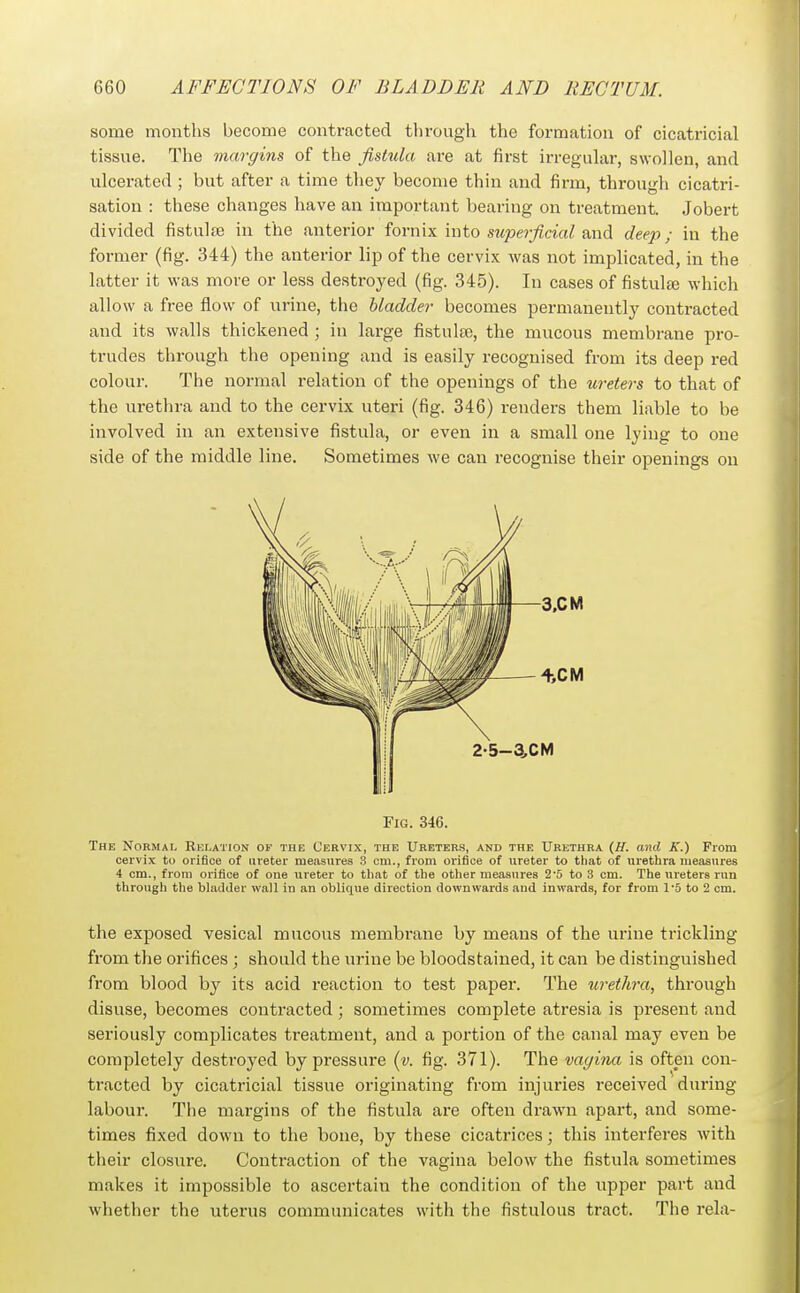 some months become contracted tlirough the formation of cicatricial tissue. The margins of the fistula are at first irregular, swollen, and ulcerated ; but after a time they become thin and firm, through cicatri- sation : these changes have an important bearing on treatment. Jobert divided fistulfe in the anterior fornix mto supeificial deep; in the former (fig. 344) the anterior lip of the cervix Avas not implicated, in the latter it was more or less destroyed (fig. 345). In cases of fistulge which allow a free flow of urine, the bladder becomes permanently contracted and its walls thickened ; in large fistula;, the mucous membrane pro- trudes through the opening and is easily recognised from its deep red colour. The normal relation of the openings of the ureters to that of the urethra and to the cervix uteri (fig. 346) renders them liable to be involved in an extensive fistula, or even in a small one lying to one side of the middle line. Sometimes we can recognise their openings on Fig. 346. The Normal Relation of the Cervix, the Uketers, and the Urethra {H. and K.) Prom cervix to orifice of ureter measures .3 cm., from orifice of ureter to that of urethra measures 4 cm., from orifice of one ureter to that of the other measures 2'5 to 3 cm. The ureters run through the bladder wall In an oblique direction downwards and invTards, for from 15 to 2 cm. the exposed vesical mucous membrane by means of the urine trickling from the orifices ; should the urine be bloodstained, it can be distinguished from blood by its acid reaction to test paper. The urethra, through disuse, becomes contracted ; sometimes complete atresia is present and seriously complicates treatment, and a portion of the canal may even be completely destroyed by pressure {y. fig. 371). The vagina is often con- tracted by cicatricial tissue originating from injuries received during labour. The margins of the fistula are often drawn apart, and some- times fixed down to the bone, by these cicatrices; this interferes with their closure. Contraction of the vagina below the fistula sometimes makes it impossible to ascertain the condition of the upper part and whether the uterus communicates with the fistulous tract. The rela-