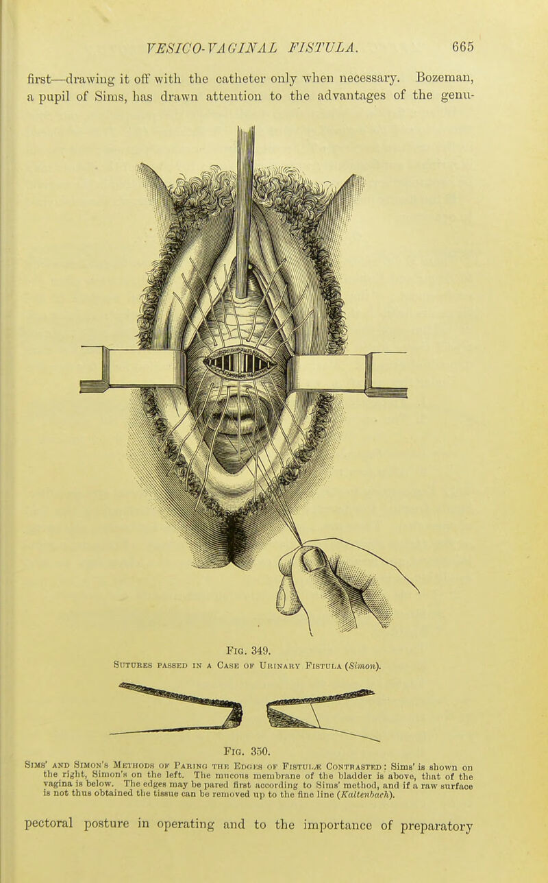 first—drawing it oflf with the catheter only when necessary. Bozeman, a pupil of Sims, has drawn attention to the advantages of the genu- FiG. 349. SnruBES PASSED IN A Case of Urinary Fistula {Simon). Fig. 350. Sims' and Simon's Metoods of Parino thk Ed(ji:s of PisTui.yE Contbastrd: Sims'is shown on the right, Simon's on the left. The mucous membrane of tlie bladder is aboTe, that of the vagina is below. The edges m.ay be pared first according to Sims' method, and if a raw surface is not thus obtained tlie tissue can be removed up to the fine line (KalUnhach). pectoral posture in operating and to the importance of preparatory