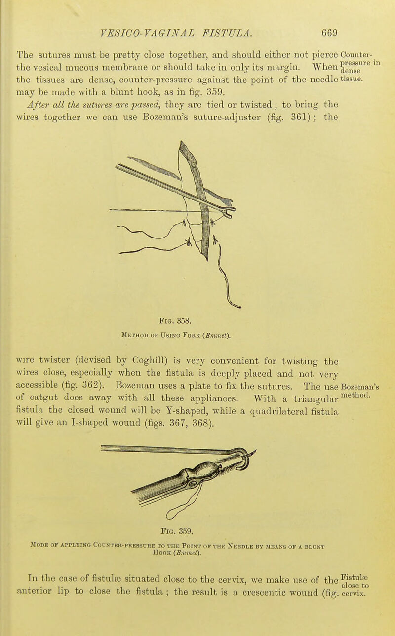 The sutures must be pretty close together, and should either not pierce Counter- the vesical mucous membrane or should take in only its margin. When demfe^^ the tissues are dense, counter-pressure against the point of the needle tissue, may be made with a blunt hook, as in fig. 359. After all the sutures are passed, they are tied or twisted; to bring the wires together we can use Bozeman's suture-adjuster (fig. 361); the Fig. 358. Method of Using Pork (Emmet). Wire twister (devised by Coghill) is very convenient for twisting the wires close, especially when the fistula is deeply placed and not very accessible (fig. 362). Bozeman uses a plate to fix the sutures. The use Bozeman's of catgut does away with all these appliances. With a triangular fistula the closed wound will be Y-shaped, while a quadrilateral fistula will give an I-shaped Avound (figs. 367, 368). Fig. 359. Mode of applying Codnter-pbessure to the Point of the Needle by means of a blunt Hook (Emviet). In the case of fistulse situated close to the cervix, we make use of the ^|^*e\^ anterior lip to close the fistula; the result is a orescentic wound (fig. cervix.