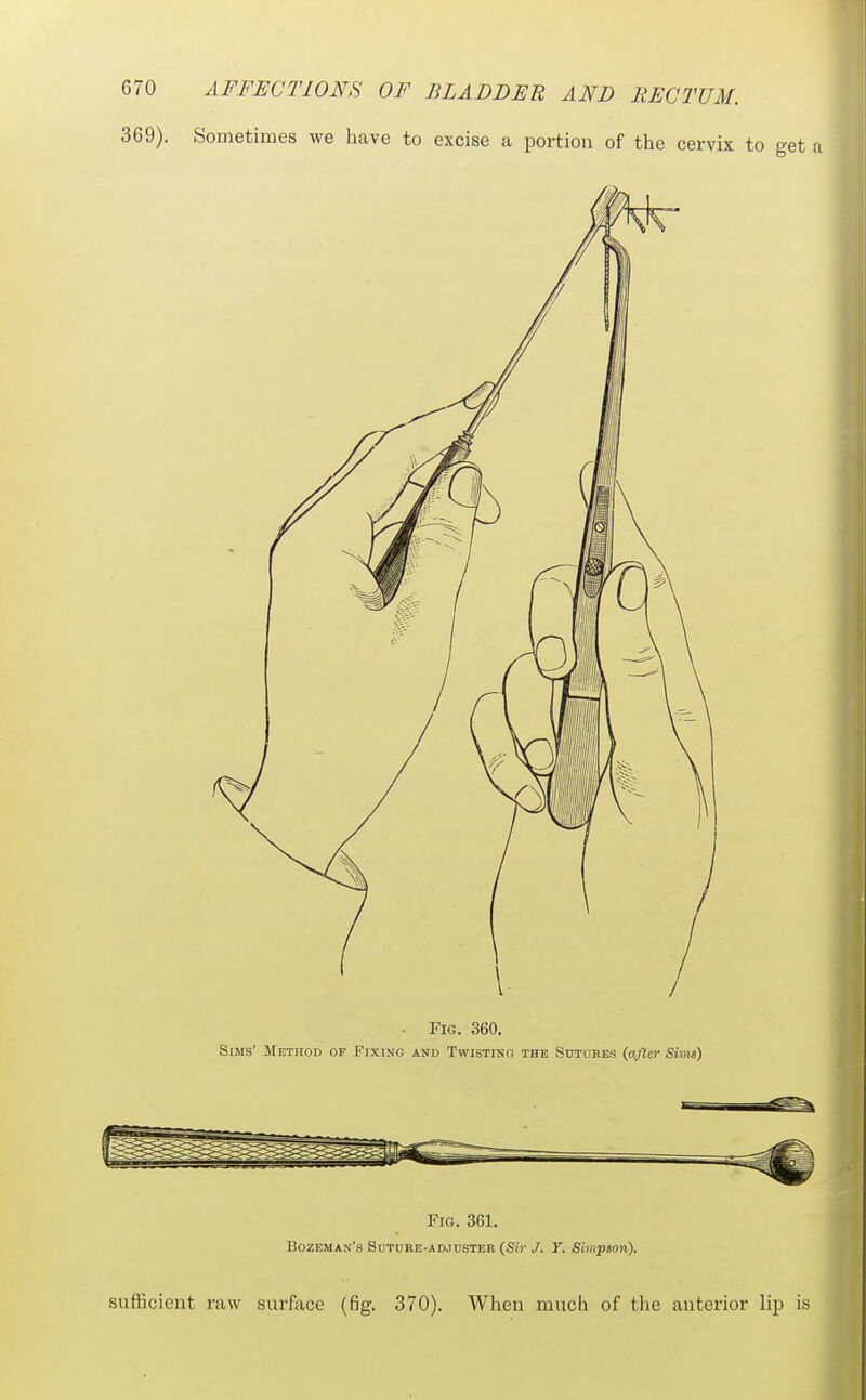 369). Sometimes we have to excise a portion of the cervix to get a • Fig. 360. Sims' Method of Fixing and Twistinh the Sutuees {after Sims) II ir°^i Fig. 361. Bozeman's SoTURE-ADJUSTER (Sf)'/. Y. Simpson). sufficient raw surface (fig. 370). When much of the anterior lij) is