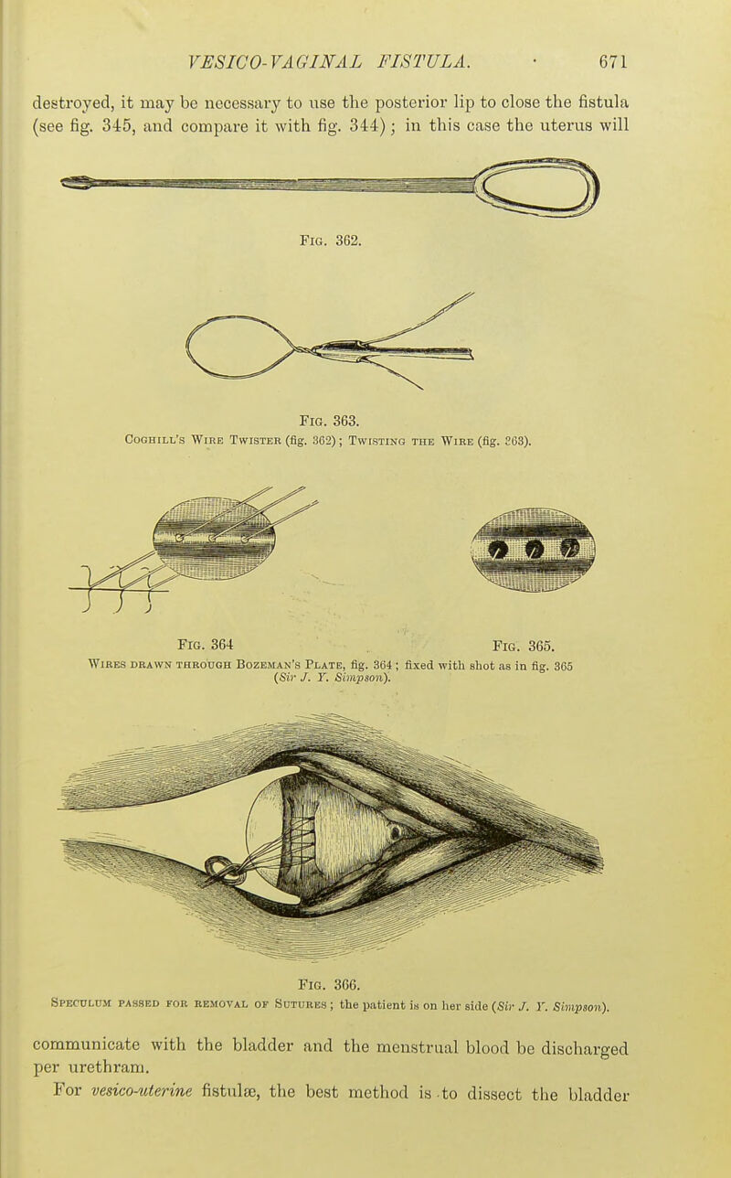 desti'oyed, it may be necessary to use the posterior lip to close the fistula (see fig. 345, and compare it with fig. 344); in this case the uterus will Fig. 363. Coghill's Wire Twister (fig. 362); Twisting the Wire (fig. 203). Fig. 364 Fig. 365. Wires drawn through Bozeman's Plate, fig. 3(34; fixed with shot as in fig. 365 {Sir J. Y. Simpson). Fig. 366. SPEO0I.UM PASSED FOR REMOVAL OF fiuTURBS; the patient is on her side (Si)- /. T. Simpson). communicate with the bladder and the menstrual blood be discharged per urethram. For vesicouterine fistulse, the best method is to dissect the bladder