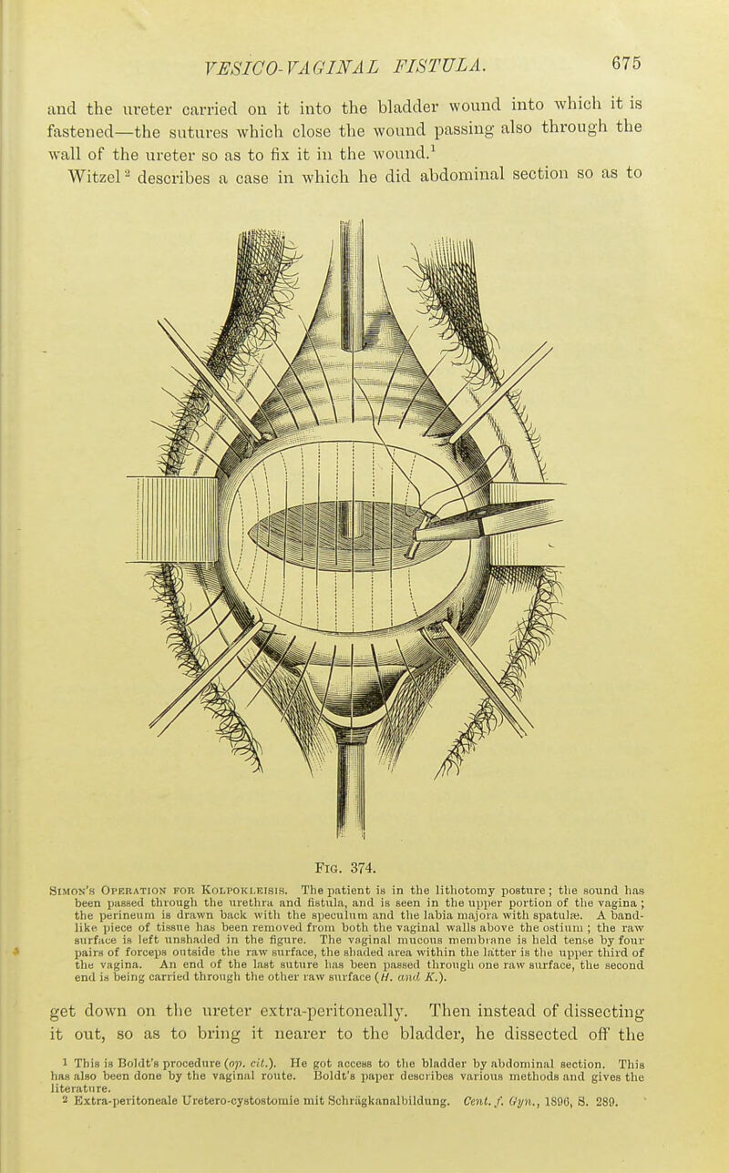 and the ureter carried ou it into the bladder wound into which it is fastened—the sutures which close the wound passing also through the wall of the ureter so as to fix it in the wound.^ Witzel - describes a case in which he did abdominal section so as to Fig. 374. Simon's Operation for Kolpokleisis. The patient is in the lithotomy posture; the sound has been passed through the urethra and fistula, and is seen in the upper portion of the vagina; the perineum is drawn back with the speculum and the labia majora with spatula). A band- like piece of tissue has been removed from both the vaginal walls above the ostium ; the raw surface is left >»nsha(led in the figure. The vaginal mucous membrane is held ten&e by four pairs of forceps outside the raw .surface, the shaded area within the Wtter is the upper third of the vagina. An end of the last suture has been passed through one raw surface, the second end is being carried through the other raw surface (W. and K.). get down on the ureter extra-peritoneally. Then instead of dissecting it out, so as to bring it nearer to the bladder, he dissected oft the 1 This is Boldt's procedure (op. cil.). He got access to the bladder by abdominal section. This has also been done by the vaginal route. IJoldt's paper describes various methods and gives the literature. 2 Extra-peritoneale Uretero-cystostomie mit Sohriigkanalbildung. Cent. f. Gyn., 8. 289.