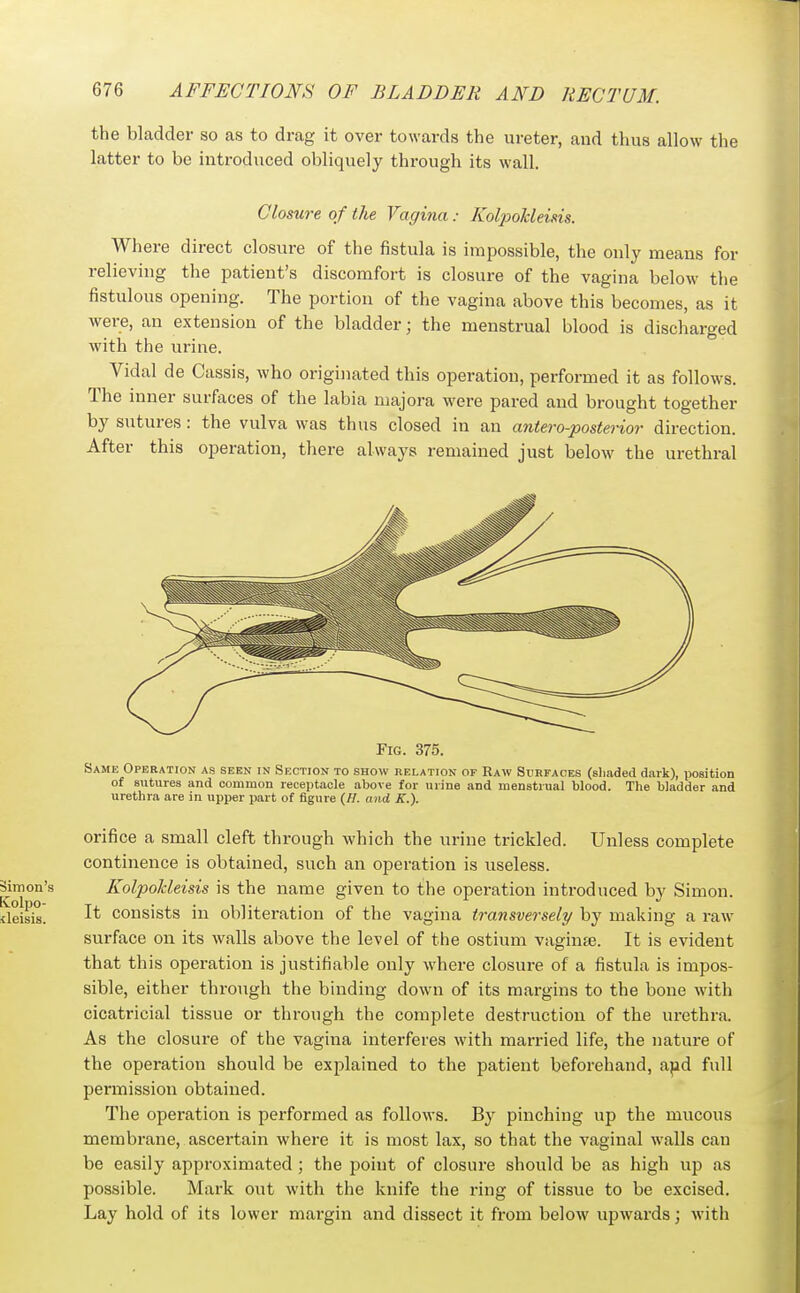 the bladder so as to drag it over towards the ureter, and thus allow the latter to be introduced obliquely through its wall. Closure of the Vagina: Kolpohleim. Where direct closure of the fistula is impossible, the only means for relieving the patient's discomfort is closure of the vagina below the fistulous opening. The portion of the vagina above this becomes, as it were, an extension of the bladder; the menstrual blood is discharged with the urine. Vidal de Cassis, who originated this operation, performed it as follows. The inner surfaces of the labia niajora wei-e pared and brought together by sutures : the vulva was thus closed in an antero-posterior direction. After this operation, there always remained just below the urethral Fig. 375. Same Operation as seen in Section to show relation of Raw Surfaces (shaded dark), xmsition of sutures and common receptacle above for urine and menstrual blood. The bladder and urethra are in upper part of figure {H. and K.). orifice a small cleft through Avhich the urine trickled. Unless complete continence is obtained, such an operation is useless. Simon's Kolpokleisis is the name given to the operation introduced by Simon. deisis. I* consists in obliteration of the vagina transversely by making a raw surface on its walls above the level of the ostium vaginte. It is evident that this operation is justifiable only where closure of a fistula is impos- sible, either through the binding down of its margins to the bone with cicatricial tissue or through the complete destruction of the urethra. As the closure of the vagina interferes with married life, the nature of the operation should be explained to the patient beforehand, apd full permission obtained. The operation is performed as follows. By pinching up the mucous membrane, ascertain where it is most lax, so that the vaginal walls can be easily approximated ; the point of closure should be as high up as possible. Mark out with the knife the ring of tissue to be excised. Lay hold of its lower margin and dissect it from below upwards; with