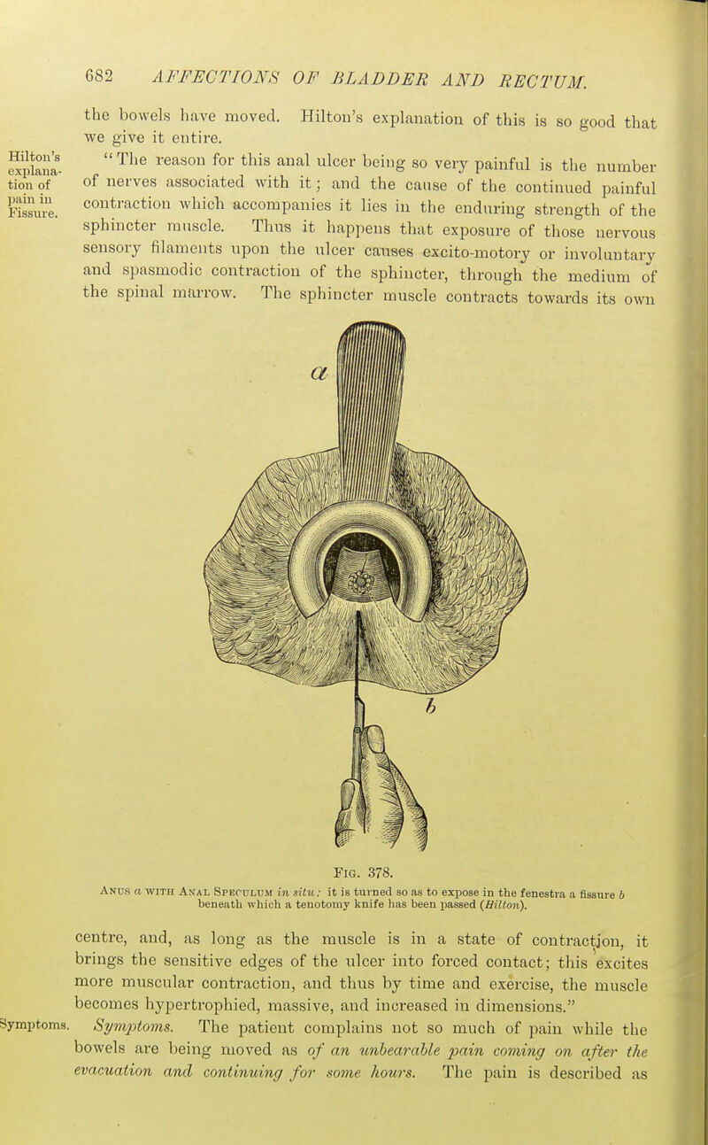 the bowels have moved. Hilton's explanation of this is so good that we give it entire. The reason for this anal ulcer being so very painful is the number of nerves associated with it; and the cause of the continued painful contraction which accompanies it lies in tlie enduring strength of the sphincter muscle. Thus it happens that exposure of those nervous sensory filaments upon the ulcer causes excito-motory or involuntary and spasmodic contraction of the sphincter, through the medium of the spinal marrow. The sphincter muscle contracts towards its own Fig. 378. Anus a with Anal Speculum in situ; it is turned so as to expose in the fenestra a fissure 6 beneath which a tenotomy knife lias been passed {Hilton). centre, and, as long as the muscle is in a state of contraction, it brings the sensitive edges of the ulcer into forced contact; this excites more muscular contraction, and thus by time and exercise, the muscle becomes hypertrophied, massive, and increased in dimensions. Symptoms. Syv^ytoms. The patient complains not so much of pain while the bowels are being moved as of an unbearable pain coming on after the evacuation and continuinff for some hours. The pain is described as