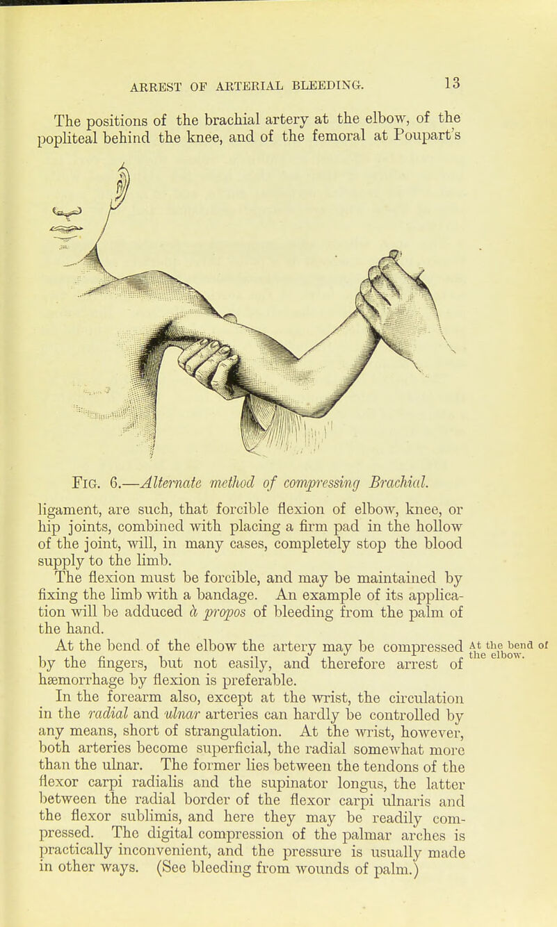 The positions of the brachial artery at the elbow, of the popliteal behind the knee, and of the femoral at Poupart's Fig. 6.—Alternate method of compressing Brachial. ligament, are such, that forcible flexion of elbow, knee, or hip joints, combined with placing a firm pad in the hollow of the joint, will, in many cases, completely stop the blood supply to the limb. The flexion must be forcible, and may be maintained by fixing the limb with a bandage. An example of its applica- tion will be adduced A propos of bleeding from the palm of the hand. At the bend of the elbow the artery may be compressed a* by the fingers, but not easily, and therefore arrest of haemorrhage by flexion is preferable. In the forearm also, except at the wrist, the circulation in the radial and ulnar arteries can hardly be controlled by any means, short of strangulation. At the wi^ist, however, both arteries become superficial, the radial somewhat more than the ulnar. The former lies between the tendons of the flexor carpi radialis and the supinator longus, the latter between the radial border of the flexor carpi ulnaris and the flexor sublimis, and here they may be readily com- pressed. The digital compression of the palmar arches is practically inconvenient, and the pressure is usually made in other ways. (See bleeding from wounds of palm.)
