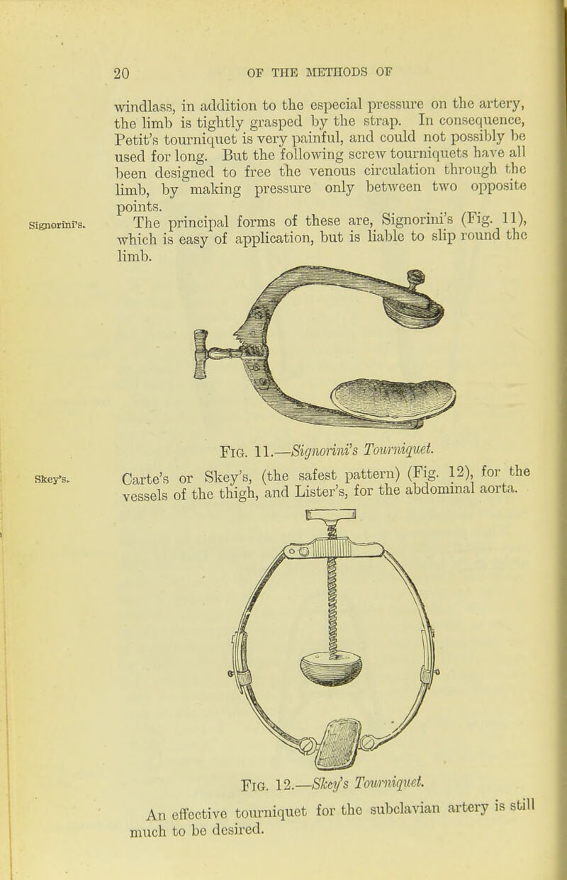 Signorinrs. windlass, in addition to the especial pressure on the artery, the limb is tightly grasped by the strap. In consequence, Petit's tourniquet is very painful, and could not possil)ly be used for long. But the following screw tourniquets have all been designed to free the venous circulation through the limb, by making pressui^e only between two opposite points. The principal forms of these are, Signorini's (Fig. 11), which is easy of application, but is liable to slip round the limb. Skey's. YiG. 11.—Signorini's Tourniquet. Carte's or Skey's, (the safest pattern) (Fig. 12) for the vessels of the thigh, and Lister's, for the abdommal aorta. ■piG, 12.—Skey's Tourniquet. An effective tourniquet for the subclavian artery is still much to be desired.