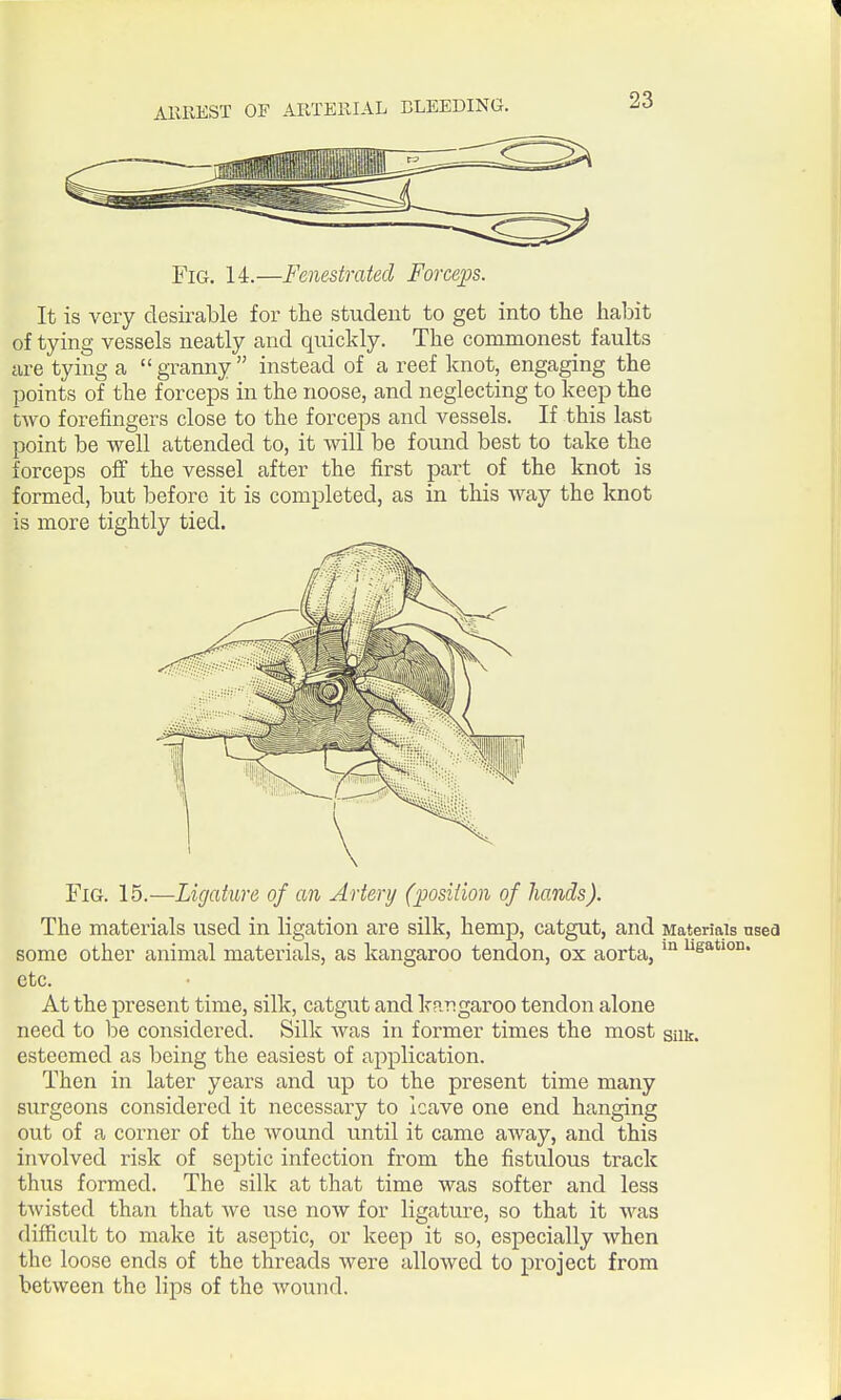 Fig. 14.—Fenestrated Forceps. It is very desirable for the student to get into the habit of tying vessels neatly and quickly. The commonest faults are tying a granny instead of a reef Icnot, engaging the points of the forceps in the noose, and neglecting to keep the two forefingers close to the forceps and vessels. If this last point be well attended to, it will be found best to take the forceps off the vessel after the first part of the knot is formed, but before it is completed, as in this way the knot is more tightly tied. Fig. 15.—Ligature of an Artery (■position of Jiands). The materials used in ligation are silk, hemp, catgut, and Materials nsea some other animal materials, as kangaroo tendon, ox aorta, etc. At the present time, silk, catgut and kangaroo tendon alone need to be considered. Silk was in former times the most snt. esteemed as being the easiest of application. Then in later years and up to the present time many surgeons considered it necessary to leave one end hanging out of a corner of the wound until it came away, and this involved risk of septic infection from the fistulous track thus formed. The silk at that time was softer and less twisted than that we use now for ligature, so that it was difficult to make it aseptic, or keep it so, especially when the loose ends of the threads were allowed to project from between the lips of the wound.