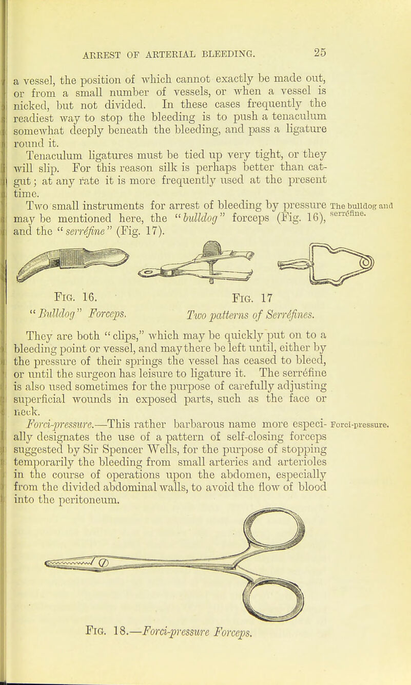a vessel, the position of whicli cannot exactly be made out, or from a small number of vessels, or when a vessel is nicked, but not divided. In these cases frequently the readiest way to stop the bleeding is to push a tenaculum somewhat deeply beneath the bleeding, and pass a ligature round it. Tenaculum ligatures must be tied up very tight, or they will slip. For this reason silk is perhaps better than cat- gut ; at any rate it is more frequently used at the present time. Two small instruments for arrest of bleeding by pressure The buiiaog and maybe mentioned hei-e, the bulldog forceps (Fig. 16)^ sen-ufiue. and the  serrdfine (Fig. 17). Fig. 16. Fig. 17  Bulldog  Forceps. Two patterns of Seirdfines. They are both  clips, which may be quickly put on to a bleeding point or vessel, and may there be left until, either by the pressure of their springs the vessel has ceased to bleed, or until the surgeon has leisure to ligature it. The serr6fine is also used sometimes for the purpose of carefully adjusting superficial wounds in exposed parts, such as the face or neck. Forci-pressure.—This rather barbarous name more especi- Foroi-pressure. ally designates the use of a pattern of self-closing forceps suggested by Sir Spencer Wells, for the purpose of stopping temporarily the bleeding from small arteries and arterioles in the course of operations upon the abdomen, especially from the divided abdominal walls, to avoid the flow of blood into the peritoneum. Fig. 18.—Forci-pressure Forceps.