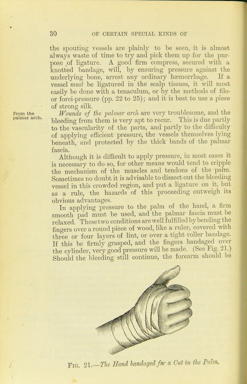 the spouting vessels are plainly to be seen, it is almost always waste of time to try and pick them up for the pur- pose of ligature. A good firm compress, secured with a knotted bandage, mil, by ensuring pressure against the underlying bone, arrest any ordinary haemorrhage. If a vessel rmist be ligatured in the scalp tissues, it vnW most easily be done with a tenaculum, or by the methods of filo- or forci-pressure (pp. 22 to 25); and it is best to use a piece of strong silk. From the JVouuds of the palmar arch are very troublesome, and the palmar arch, -^^gg^j^j^g ^^^^ jg ygry apt to recur. This is due partly to the vascularity of the parts, and partly to the difhculby of applying efficient pressiu-e, the vessels themselves lying beneath, and protected by the thick bands of the palmar fascia. Although it is difficult to apply pressure, in most cases it is necessary to do so, for other means would tend to cripple the mechanism of the muscles and tendons of the palm. Sometimes no doubt it is advisable to dissect out the bleeding vessel in this crowded region, and j)ut a ligatiu'e on it, but as a rule, the hazards of this proceeding outweigh its obvious advantages. In applying pressure to the palm of the hand, a firm smooth pad must be used, and the palmar fascia must be relaxed. These two conditions are well fulfilled by bending the fingers over a round piece of wood, like a ruler, covered vnth. three or four layers of lint, or over a tight roller bandage. If this be firmly grasped, and the fingers bandaged over the cylinder, very good pressure will be made. (See Fig. 21.) Should the bleeding still continue, the forearm should lie YiG. 2l.~-The Hand bandaged far a Cut in the Palm.