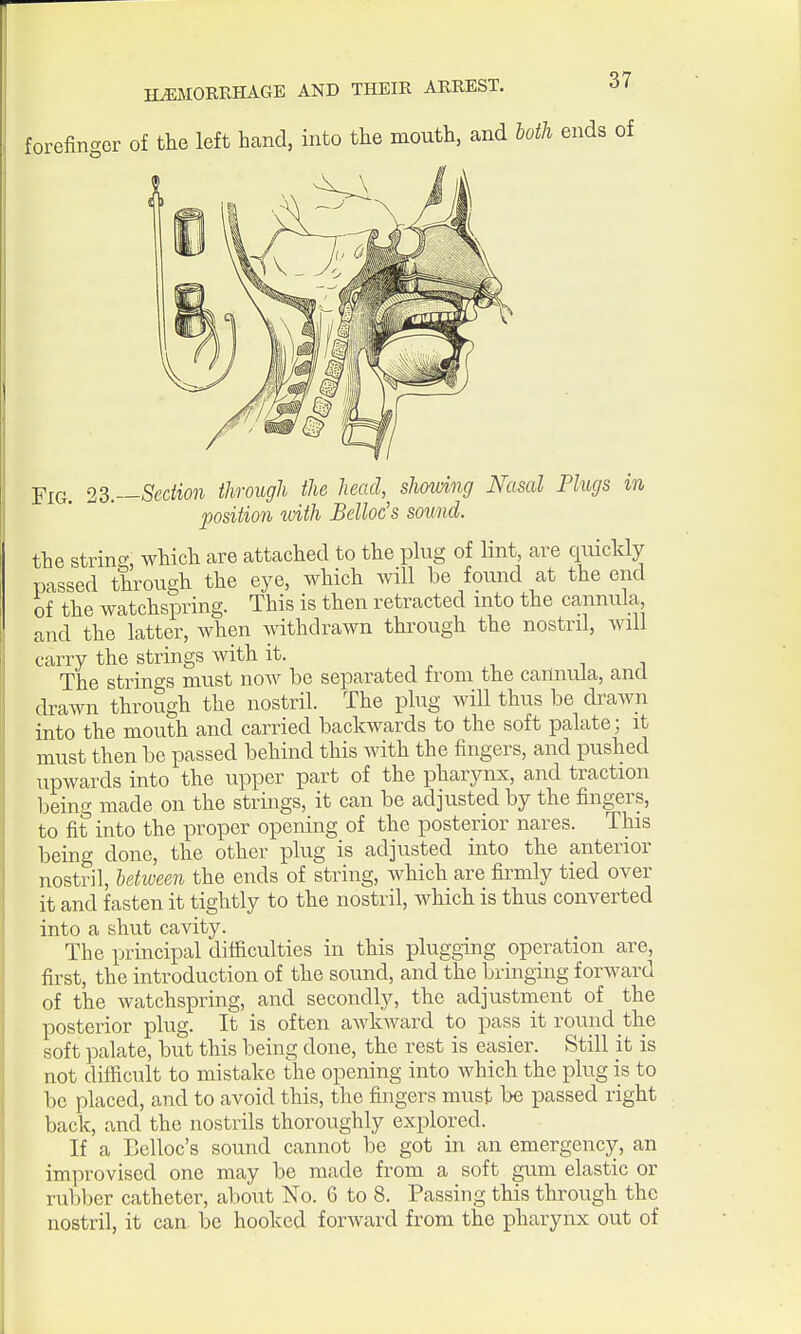 forefin<^er of the left hcand, into the mouth, and loth ends of Fig. 1^.—Section through the head, showing Nasal Plugs in position with Bclloc's sound. the string, which are attached to the plug of lint, are quickly passed through the eye, which will be found at the end of the watchspring. This is then retracted into the cannula, and the latter, when withdrawn through the nostril, will carry the strings with it. ., , , i i The strings must noAv be separated from the cannula, and drawn through the nostril. The plug will thus be drawn into the mouth and carried backwards to the soft palate; it must then be passed behind this with the fingers, and pushed upwards into the upper part of the pharynx, and traction being made on the strings, it can be adjusted by the fingers, to fit into the proper opening of the posterior nares. This being done, the other plug is adjusted into the anterior nostril, between the ends of string, Avhich are firmly tied over it and fasten it tightly to the nostril, which is thus converted into a shut cavity. The principal difficulties in this plugging operation are, first, the introduction of the sound, and the bringing forward of the watchspring, and secondly, the adjustment of the posterior plug. It is often aAvkward to pass it round the soft palate, but this being done, the rest is easier. Still it is not difficult to mistake the opening into which the plug is to be placed, and to avoid this, the fingers must be passed right back, and the nostrils thoroughly explored. If a Belloc's sound cannot be got in an emergency, an improvised one may be made from a soft gvim elastic or rubber catheter, about No. 6 to 8. Passing this through the nostril, it can. be hooked forward from the pharynx out of