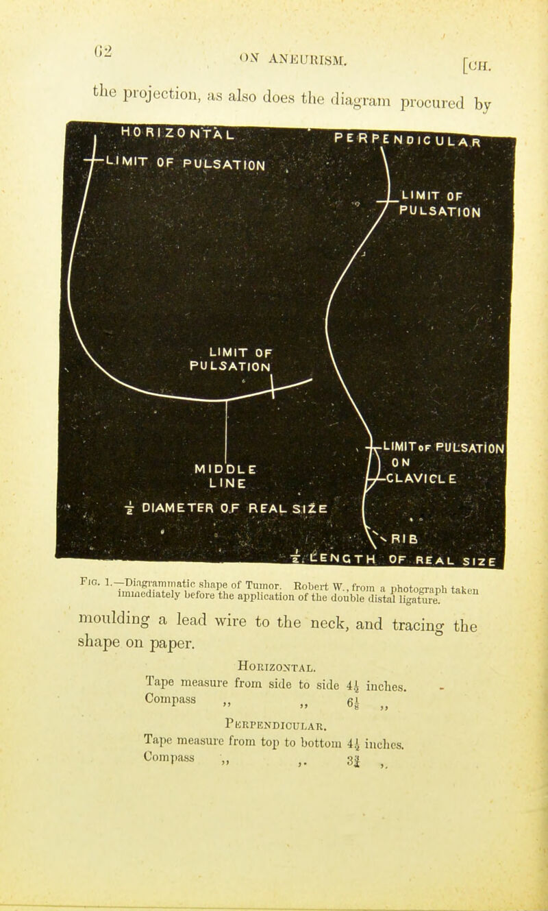 the projection, as also does the diaoram procured by Fig. l.-Diagraminatic shape of Tumor. Eobert W.. from a photoeranh take, immediately before the application of the double distanigat^re moulding a lead wire to the neck, and tracing the shape on paper. Horizontal. Tape measure from side to side 4 4 inches. Compass „ „ Pkrpendicular. Tape measure from top to bottom 4.i inches. Compass „ 3|
