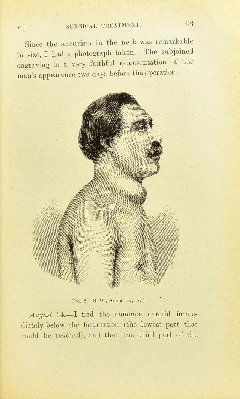 v.] SURGICAL TRKATMKNT. Since the aneuvisni iu tlie neck was remarkable in size, I had a photograph taken. The subjoined engraving is a very faithful representation of the man's appearance two days before the operation. August 14.—I tied the common carotid imme- diately below the bifurcation (the lowest part that could be reached), and then the tliird part of the