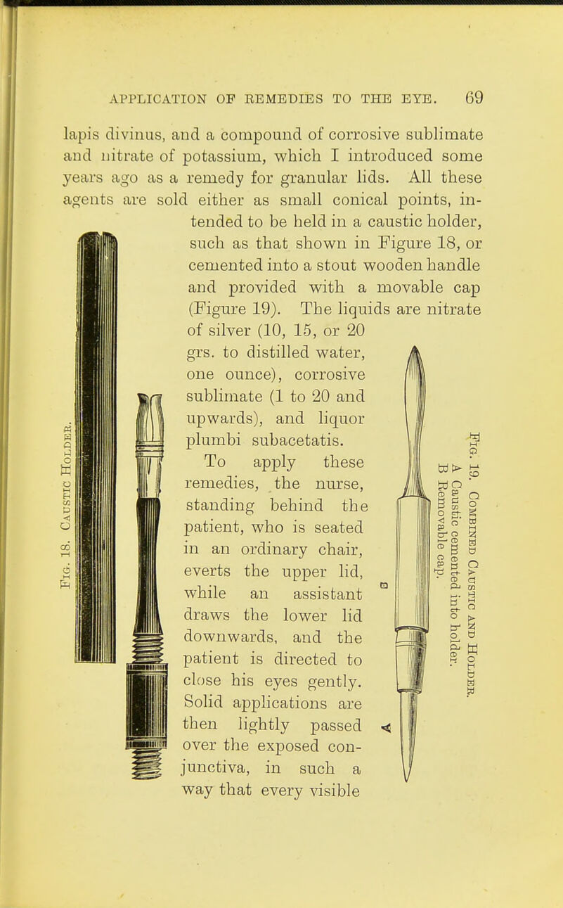 O O lapis divinus, and a compound of corrosive sublimate and nitrate of potassium, which I introduced some years ago as a remedy for granular lids. All these agents are sold either as small conical points, in- tended to be held in a caustic holder, such as that shown in Figure 18, or cemented into a stout wooden handle and provided with a movable cap (Figure 19). The liquids are nitrate of silver (10, 15, or 20 grs. to distilled water, one ounce), corrosive sublimate (1 to 20 and upwards), and liquor plumbi subacetatis. To apply these remedies, the nurse, standing behind the patient, who is seated in an ordinary chair, everts the upper lid, while an assistant ' draws the lower lid downwards, and the patient is directed to close his eyes gently. Solid applications are then lightly passed • over the exposed con- junctiva, in such a way that every visible WO ' 2 § Q SS o o 3- g ^ 5 w e> a i—-CD M » B g I § 9