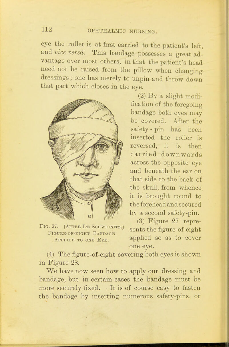 eye the roller is at first carried to the patient's left, and vice versd. This bandage possesses a great ad- vantage over most others, in that the patient's head need not be raised from the pillow when changing dressings; one has merely to unpin and throw down that part which closes in the eye. (2) By a slight modi- fication of the foregoing bandage both eyes may be covered. After the safety-pin has been inserted the roller is reversed, it is then carried downwards across the opposite eye and beneath the ear on that side to the back of the skull, from whence it is brought round to the forehead and secured by a second safety-pin. (3) Figure 27 repre- sents the figure-of-eight applied so as to cover one eye. (4) The figure-of-eight covering both eyes is shown in Figure 28. We have now seen how to apply our dressing and bandage, but in certain cases the bandage must be more securely fixed. It is of course easy to fasten the bandage by inserting numerous safety-pins, or Fig. 27. (Afteh De Schweinitz.) flguke-of-eight bandage Applied to one Eye.