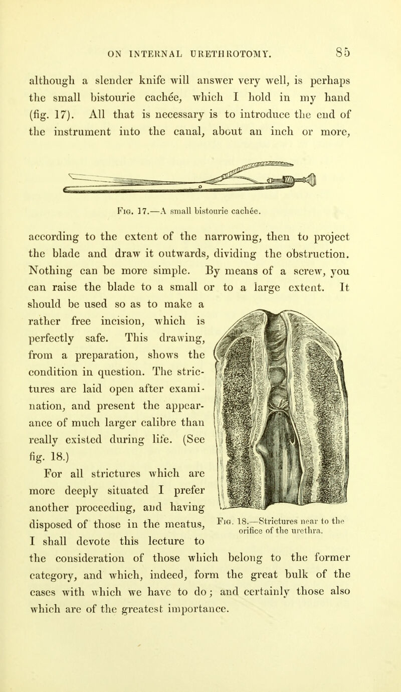 althougli a slender knife will answer very well, is perhaps the small bistourie cachee, which I hold in my hand (fig. 17). All that is necessary is to introduce the end of the instrument into the canal; about an inch or more, Fig. 17.—A small bistourie cachee. according to the extent of the narrowing, then to project the blade and draw it outwards, dividing the obstruction. Nothing can be more simple. By means of a screw, you can raise the blade to a small or to a large extent. It should be used so as to make a rather free incision, which is perfectly safe. This drawing, from a preparation, shows the condition in question. The stric- tures are laid open after exami- nation, and present the appear- ance of much larger calibre than really existed during life. (See fig. 18.) For all strictures which are more deeply situated I prefer another proceeding, and having disposed of those in the meatus, I shall devote this lecture to the consideration of those which belong to the former category, and Avhich, indeed, form the great bulk of the cases with which we have to do; and certainly those also which are of the greatest importance. Fjg. 18.—Strictures near to the orifice of the urethra.