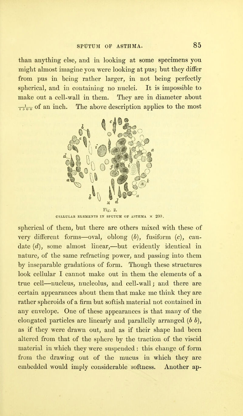 than anything else, and in looking at some specimens you might almost imagine you were looking at pus; but they differ from pus in being rather larger, in not being perfectly spherical, and in containing no nuclei. It is impossible to make out a cell-wall in them. They are in diameter about TTWo inch. The above description applies to the most Fi^-. 2. CELLULAR ELEMENTS IN SPUTUM OF ASTHMA X 200. spherical of them, but there are others mixed with these of very diflPerent forms—oval, oblong (b), fusiform (c), cau- date {d), some almost linear,—but evidently identical in nature, of the same refracting power, and passing into them by inseparable gradations of form. Though these structures look cellular I cannot make out in them the elements of a true cell—nucleus, nucleolus, and cell-wall; and there are certain appearances about them that make me think they are rather spheroids of a firm but softish material not contained in any envelope. One of these appearances is that many of the elongated particles are linearly and parallelly arranged {b b), as if they were drawn out, and as if their shape had been altered from that of the sphere by the traction of the viscid material in which they were suspended ; this change of form from the drawing out of the mucus in which they are embedded would imply considerable softness. Another ap-