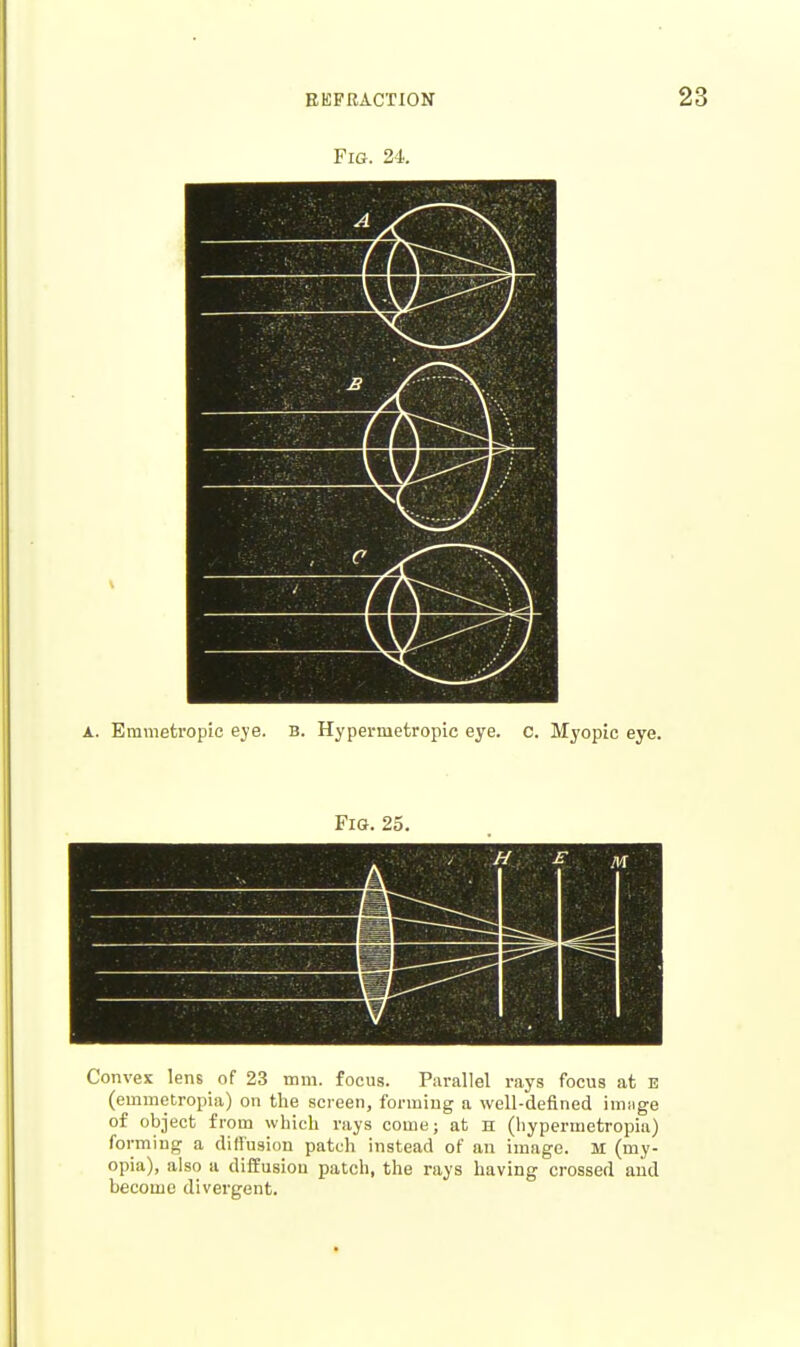 Fig. 24. A. Emmetropic eye. B. Hypermetropic eye. c. Myopic eye. Fig. 25. Conves lens of 23 mm. focus. Parallel rays focus at e (emmetropia) on the screen, forming a well-defined image of object from which rays come; at n (hypermetropia) forming a diflusion patch instead of an image. H (my- opia), also a diilusiou patch, the rays having crossed and become divergent.
