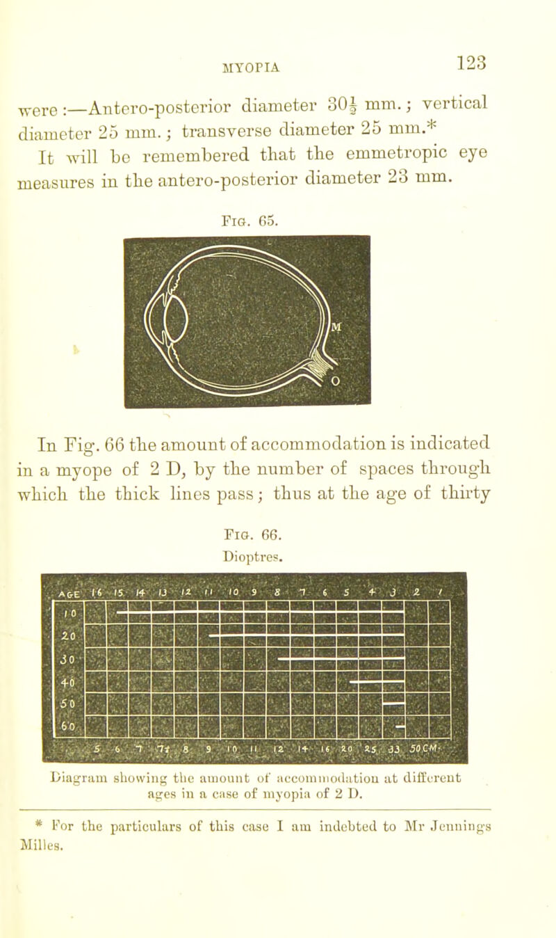 ^ere :—Antero-posterior diameter BQi mm.; vertical diameter 25 mm.; transverse diameter 25 mm.* It will be remembered that the emmetropic eye measures in the antero-posterior diameter 23 mm. Pig. 65. In Fig. 66 the amount of accommodation is indicated in a myope of 2 by the number of spaces through which the thick lines pass; thus at the age of thirty Fig. 66. Dioptres. Diagram showing the amount of accomiiioilatiou at (lifforeut ages in a case of myopia of 2 D. * For the particulars of this case I am indebted to Mr Jennings MiUes.
