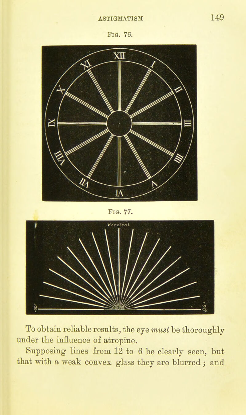 Fig. 76. To obtain reliable results^ tbe eye must be tboroughly under the influence of atropine. Supposing lines from 12 to 6 be clearly seen, but tbat witb a weak convex glass tbey are blurred ; and