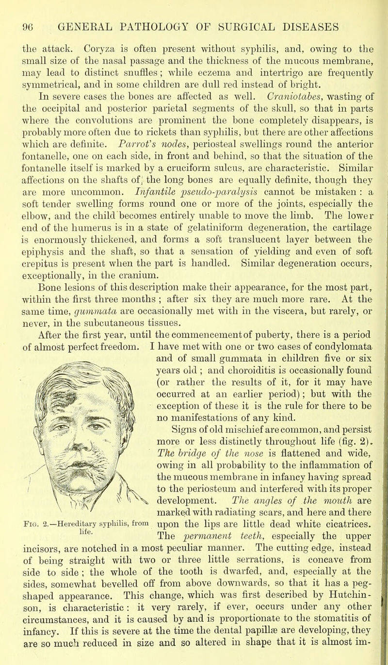 the attack. Coryza is often present without syphilis, and, owing to the small size of the nasal passage and the thickness of the mucous membrane, may lead to distinct snuffles; while eczema and intertrigo are frequently symmetrical, and in some children are dull red instead of bright. In severe cases the bones are affected as well. Craniotabes, wasting of the occipital and posterior parietal segments of the skull, so that in parts where the convolutions are prominent the bone completely disappears, is probably more often due to rickets than syphilis, but there are other affections Avhich are definite. Parrot's nodes, periosteal swellings round the anterior fontanelle, one on each side, in front and behind, so that the situation of the fontanelle itself is marked by a cruciform sulcus, are characteristic. Similar affections on the shafts of | the long bones are equally definite, though they are more uncommon. Infantile 2^seudo-paralysis cannot be mistaken : a soft tender swelhng forms round one or more of the joints, especially the elbow, and the child becomes entirely unable to move the limb. The lower end of the humerus is in a state of gelatiniform degeneration, the cartilage is enormously thickened, and forms a soft translucent layer between the epiphysis and the shaft, so that a sensation of yielding and even of soft crepitus is present when the part is handled. Similar degeneration occurs, exceptionally, in the cranium. Bone lesions of this description make their appearance, for the most part, within the first three months ; after six they are much more rare. At the same time, gummata are occasionally met with in the viscera, but rarely, or never, in the subcutaneous tissues. After the first year, until the commencement of puberty, there is a period of almost perfect freedom. I have met with one or two cases of condylomata and of small gummata in children five or six years old ; and choroiditis is occasionally found (or rather the results of it, for it may have occurred at an earlier period); but with the exception of these it is the rule for there to be no manifestations of any kind. Signs of old mischief are common, and persist more or less distinctly throughout life (fig. 2). Tile bridge of the nose is flattened and wide, owing in all probability to the inflammation of the mucous membrane in infancy having spread to the periosteum and interfered with its proper \ \^ '^^^ development. TJie angles of the mouth are ^ ' ^ marked with radiating scars, and here and there Fig. 2.—Hereditary sypliilis, from upon the lips are little dead white cicatrices. The permanent teeth, especially the upper incisors, are notched in a most peculiar manner. The cutting edge, instead of being straight with two or three little serrations, is concave from side to side ; the whole of the tooth is dwarfed, and, especially at the sides, somewhat bevelled off from above downwards, so that it has a peg- shaped appearance. This change, which was first described by Hutchin- son, is characteristic : it very rarely, if ever, occurs under any other circumstances, and it is caused by and is proportionate to the stomatitis of infancy. If this is severe at the time the dental papillfe are developing, they are so much reduced in size and so altered in shape that it is almost im-