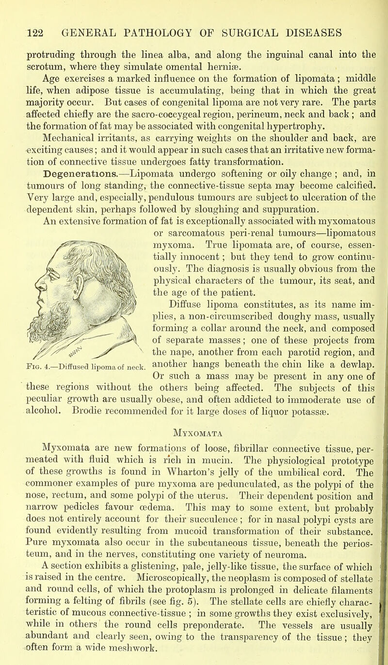 protruding through the linea alba, and along the inguinal canal into the scrotum, where they simulate omental hernife. Age exercises a marked influence on the formation of lipomata ; middle life, when adipose tissue is accumulating, being that in which the great majority occur. But cases of congenital lipoma are not very rare. The parts alfected chiefly are the sacro-coccygeal regioii, perineum, neck and back ; and the formation of fat may be associated with congenital hypertrophy. Mechanical irritants, as carrying weights on the shoulder and back, are exciting causes; and it would appear in such cases that an irritative new forma- tion of connective tissue undergoes fatty transformation. Degenerations.—Lipomata undergo softening or oily change ; and, in tumours of long standing, the connective-tissue septa may become calcified. Very large and, especially, pendulous tumours are subject to ulceration of the dependent skin, perhaps followed by sloughing and suppuration. An extensive formation of fat is exceptionally associated with myxomatous or sarcomatous peri-renal tumours—hpomatous myxoma. True lipomata are, of course, essen- tially innocent; but they tend to grow continu- ously. The diagnosis is usually obvious from the physical characters of the tumour, its seat, and the age of the patient. Diffuse lipoma constitutes, as its name im- plies, a non-circumscribed doughy mass, usually forming a collar around the neck, and composed of separate masses; one of these projects from the nape, another from each parotid region, and Fig. 4.—Diffused lipoma of neck, another hangs beneath the chin like a dewlap. Or such a mass may be present in any one of these regions without the others being affected. The subjects of this peculiar growth are usually obese, and often addicted to immoderate use of alcohol. Brodie recommended for it large doses of liquor potass^. Myxomata Myxomata are new formations of loose, fibrillar connective tissue, per- meated with fluid which is rich in mucin. The physiological prototype of these growths is found in Wharton's jelly of the umbilical cord. The commoner examples of pure myxoma are pedunculated, as the polypi of the nose, rectum, and some polypi of the uterus. Their dependent position and narrow pedicles favour oedema. This may to some extent, but probably does not entirely account for their succulence; for in nasal polypi cysts are found evidently resulting from mucoid transformation of their substance. Pure myxomata also occur in the subcutaneous tissue, beneath the perios- teum, and in the nerves, constituting one variety of neuroma. A section exhibits a glistening, pale, jelly-like tissue, the surface of which is raised in the centre. Microscopically, the neoplasm is composed of stellate and round cells, of which the protoplasm is prolonged in delicate filaments forming a felting of fibrils (see fig. 5). The stellate cells are chiefly charac- teristic of mucous connective-tissue ; in some growths they exist exclusively, while in others the round cells preponderate. The vessels are usually abundant and clearly seen, owing to the transparency of the tissue; they often form a wide mesliwork.