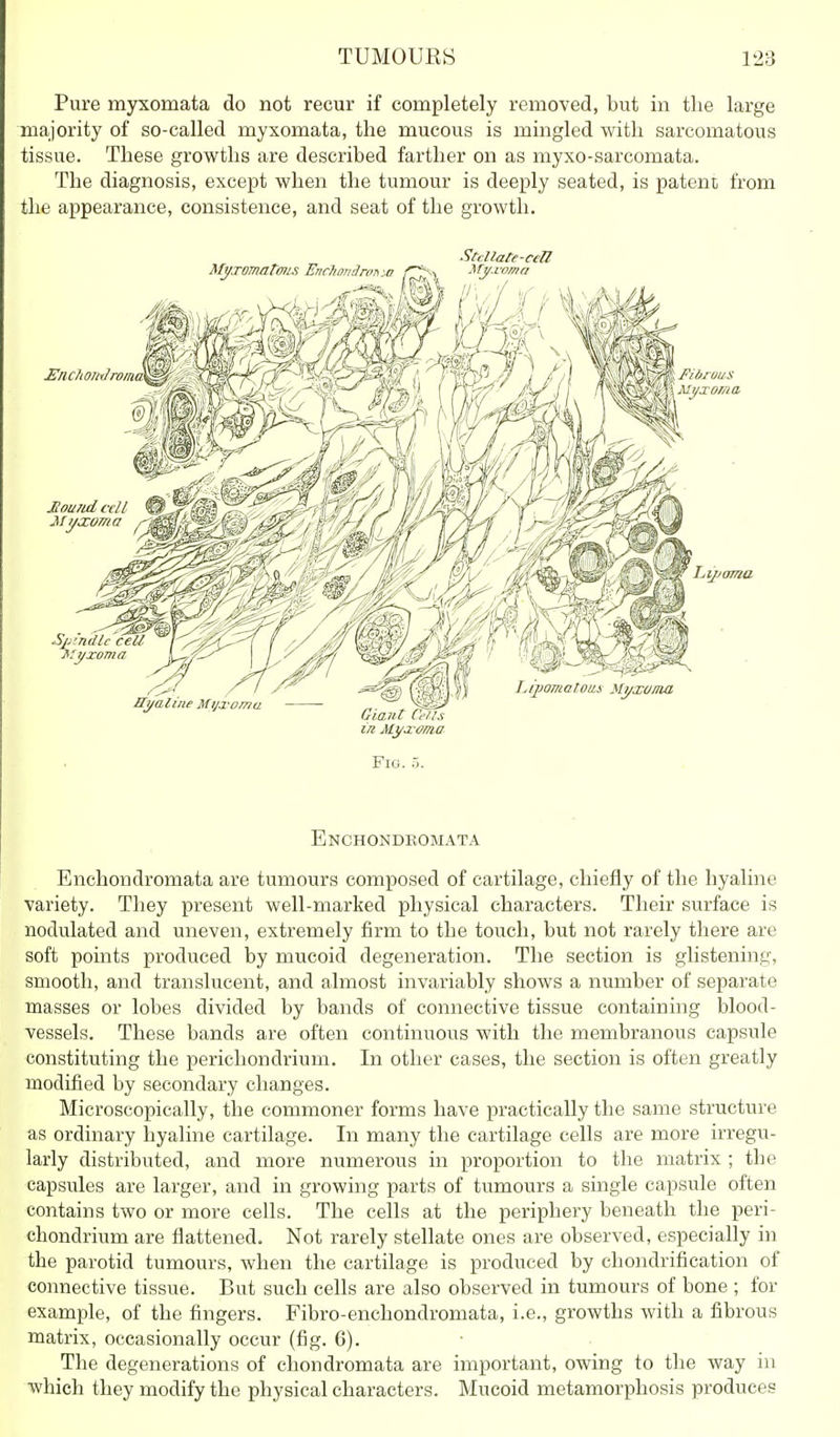 Pure myxomata do not recur if completely removed, but in the large majority of so-called myxomata, the mucous is mingled with sarcomatous tissue. These growths are described farther on as myxo-sarcomata. The diagnosis, except when the tumour is deeply seated, is patent from the appearance, consistence, and seat of the growth. Stcllate-cell in Myaroma Fio. 5. Enchondbomata Enchondromata are tumours composed of cartilage, chiefly of the hyaline variety. They present well-marked physical characters. Their surface is nodulated and uneven, extremely firm to the touch, but not rarely there are soft points produced by mucoid degeneration. The section is glistening, smooth, and translucent, and almost invariably shows a number of separate masses or lobes divided by bands of connective tissue containing blood- vessels. These bands are often continuous with the membranous capsule constituting the perichondrium. In other cases, the section is often greatly modified by secondary changes. Microscopically, the commoner forms have practically the same structure as ordinary hyaline cartilage. In many the cartilage cells are more irregu- larly distributed, and more numerous in proportion to the matrix ; the capsides are larger, and in growing parts of tumours a single capsule often contains two or more cells. The cells at the periphery beneath the peri- chondrium are flattened. Not rarely stellate ones are observed, especially in the parotid tumours, when the cartilage is produced by chondrification of connective tissue. But such cells are also observed in tumours of bone ; for example, of the fingers. Fibro-enchondromata, i.e., growths with a fibrous matrix, occasionally occur (fig. G). The degenerations of chondromata are important, owing to the way in Avhich they modify the physical characters. Mucoid metamorphosis produces