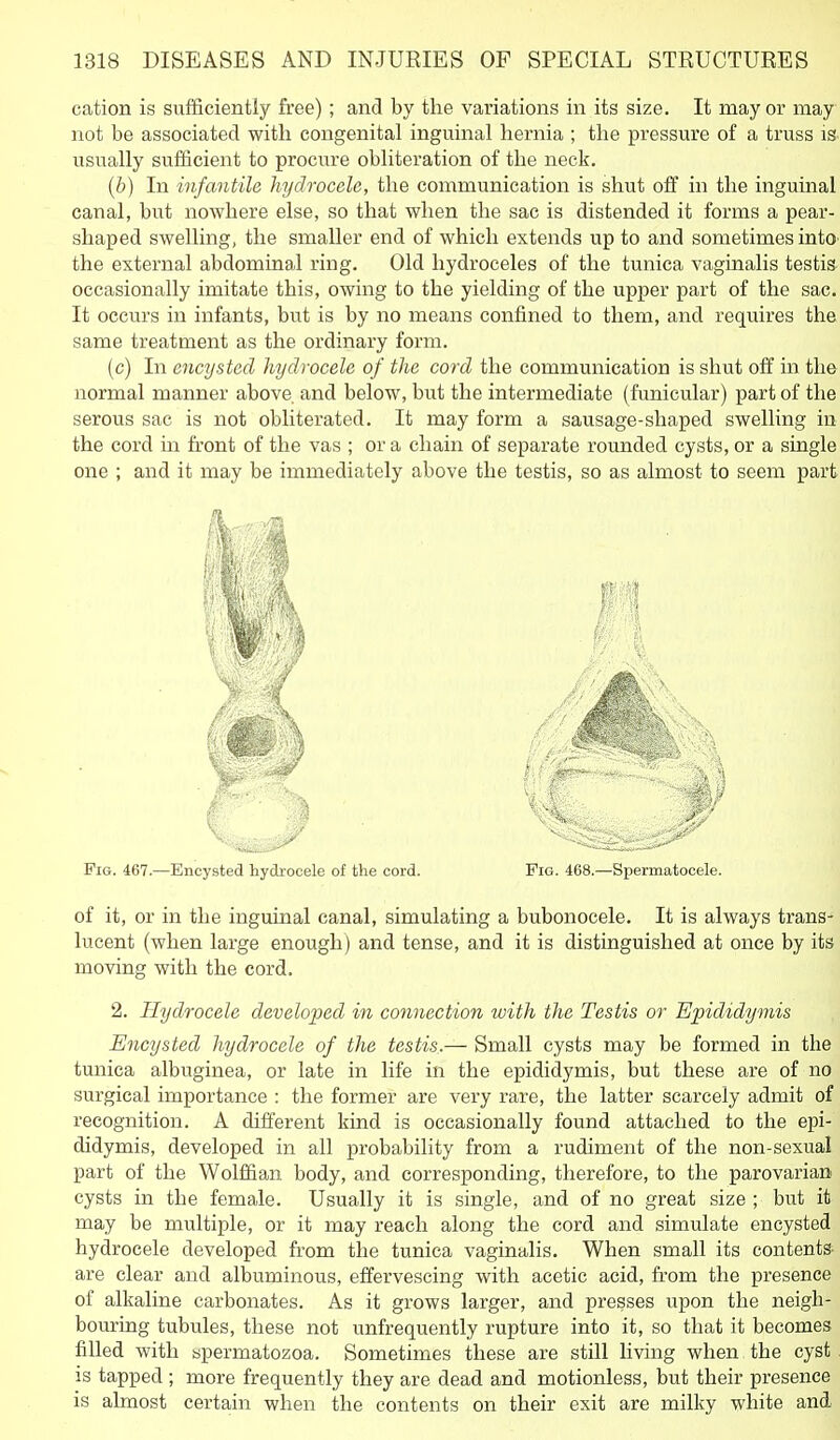 cation is sufficiently free); and by the variations in its size. It may or may not be associated with congenital inguinal hernia ; the pressure of a truss is usually sufficient to procure obliteration of the neck. (6) In infantile hydrocele, the communication is shut off in the inguinal canal, but nowhere else, so that when the sac is distended it forms a pear- shaped swelling, the smaller end of which extends up to and sometimes intO' the external abdominal ring. Old hydroceles of the tunica vaginalis testis occasionally imitate this, owing to the yielding of the upper part of the sac. It occurs in infants, but is by no means confined to them, and requires the same treatment as the ordinary form. (c) In encysted hydrocele of the cord the communication is shut off in the normal manner above, and below, but the intermediate (funicular) part of the serous sac is not obliterated. It may form a sausage-shaped swelling in the cord m front of the vas ; or a chain of separate rounded cysts, or a single one ; and it may be immediately above the testis, so as almost to seem part Fig. 467.—Encysted hydrocele of the cord. Fig. 468.—Spermatocele. of it, or in the inguinal canal, simulating a bubonocele. It is always trans- lucent (when large enough) and tense, and it is distinguished at once by its moving with the cord. 2. Hydrocele developed in connection with the Testis or Epididymis Encysted hydrocele of the testis.— Small cysts may be formed in the tunica albuginea, or late in life in the epididymis, but these are of no surgical importance : the former are very rare, the latter scarcely admit of recognition. A different kind is occasionally found attached to the epi- didymis, developed in ail probability from a rudiment of the non-sexual part of the Wolffian body, and corresponding, therefore, to the parovarian cysts in the female. Usually it is single, and of no great size ; but it may be multiple, or it may reach along the cord and simulate encysted hydrocele developed fi-om the tunica vaginalis. When small its contents- are clear and albuminous, effervescing with acetic acid, from the presence of alkaline carbonates. As it grows larger, and presses upon the neigh- bouring tubules, these not unfrequently rupture into it, so that it becomes filled with spermatozoa. Sometimes these are still Hving when the cyst is tapped ; more frequently they are dead and motionless, but their presence is almost certain when the contents on their exit are milky white and