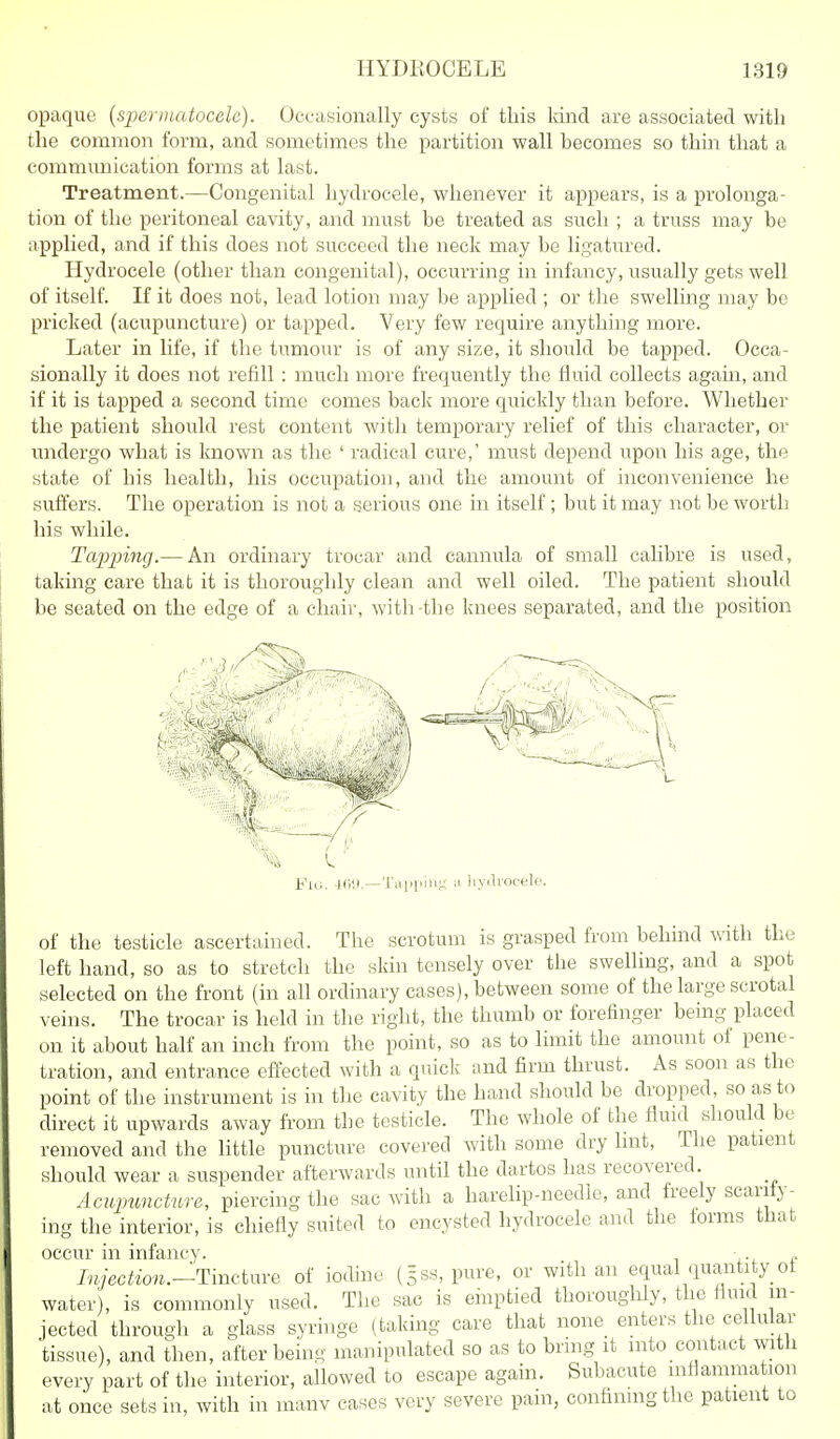 opaque [spermatocele). Occasionally cysts of this land are associated with the common form, and sometimes the partition wall becomes so thin that a communication forms at last. Treatment.—Congenital hydrocele, whenever it appears, is a prolonga- tion of the peritoneal cavity, and must be treated as such ; a truss may be applied, and if this does not succeed the neck may be ligatured. Hydrocele (other than congenital), occurring in infancy, usually gets well of itself. If it does not, lead lotion may be applied ; or the swelling may be pricked (acupuncture) or tapped. Very few require anything more. Later in life, if the tumour is of any size, it should be tapped. Occa- sionally it does not refill : much more frequently the fluid collects again, and if it is tapped a second time comes back more quickly than before. Whether the patient should rest content with temporary relief of this character, or undergo what is known as the ' radical cure,' must depend upon his age, the state of his health, his occupation, and the amount of inconvenience he suffers. The operation is not a serious one in itself; but it may not be worth his while. Tapping.— An ordinary trocar and cannula of small calibre is used, taking care that it is thoroughly clean and well oiled. The patient should be seated on the edge of a chair, with the knees separated, and the position Fig. aC)!).—'J'iqipiii.u a hyiliocele. of the testicle ascertained. The scrotum is grasped from behind with the left hand, so as to stretch the skin tensely over the swelling, and a spot selected on the front (in all ordinary cases), between some of the large scrotal veins. The trocar is held in the right, the thumb or forefinger being placed on it about half an inch from the point, so as to limit the amount of pene- tration, and entrance effected with a quick and firm thrust. As soon as the point of the instrument is in the cavity the hand should be dropped, so as to direct it upwards away from the testicle. The whole of the fluid should be removed and the little puncture covered with some dry Imt, The patient should wear a suspender afterwards until the dartos has recovered. AcupimchLve, piercing the sac with a harelip-needle, and freely scarify- ing the interior, is chiefly suited to encysted hydrocele and the forms that occur in infancy. „ Ivyec^^on.-Tincture of iodine (5SS, pure, or with an equal quantity of water), is commonly used. The sac is einptied thoroughly, the fluid in- jected through a glass syringe (taking care that none enters the cellular tissue), and then, after being manipulated so as to bring it into contact with every part of the interior, allowed to escape again. Subacute inflammation at once sets in, with in manv eases very severe pain, confining the patient to