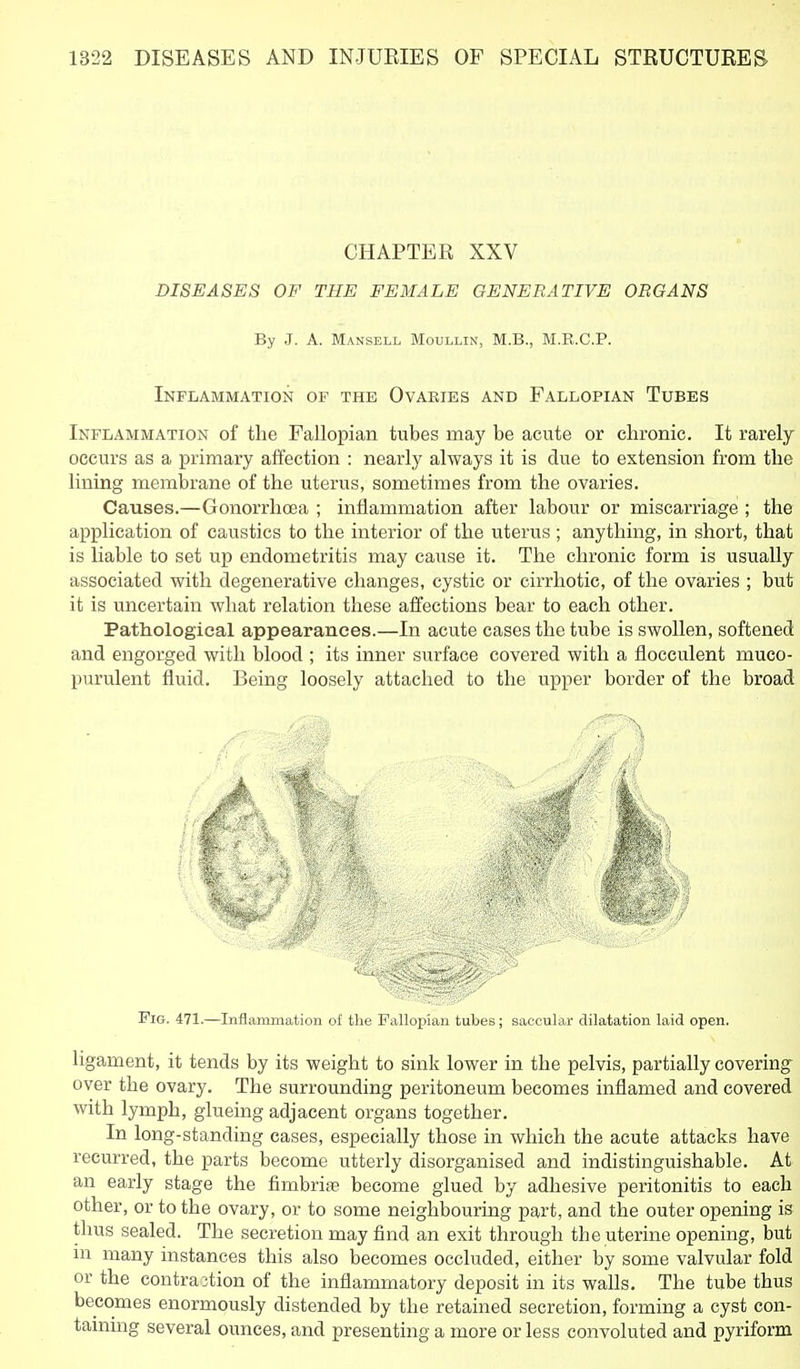 CHAPTER XXV DISEASES OF THE FEMALE GENERATIVE ORGANS By J. A. Mansell Moullin, M.B., M.K.C.P. Inflammation op the Ovabies and Fallopian Tubes Inflammation of the Fallopian tubes may be acute or chronic. It rarely occurs as a primary affection : nearly always it is due to extension from the lining membrane of the uterus, sometimes from the ovaries. Causes.—Gonorrhoea ; inflammation after labour or miscarriage ; the application of caustics to the interior of the uterus ; anything, in short, that is liable to set up endometritis may cause it. The chronic form is usually associated with degenerative changes, cystic or cirrhotic, of the ovaries ; but it is uncertain what relation these affections bear to each other. Pathological appearances.—In acute cases the tube is swollen, softened and engorged with blood ; its inner surface covered with a flocculent muco- purulent fluid. Being loosely attached to the upper border of the broad Pig. 471.—Inflammation of the Fallopian tubes; saccular dilatation laid open. ligament, it tends by its weight to sink lower in the pelvis, partially covering over the ovary. The surrounding peritoneum becomes inflamed and covered with lymph, glueing adjacent organs together. In long-standing cases, especially those in which the acute attacks have recurred, the parts become utterly disorganised and indistinguishable. At an early stage the fimbriae become glued by adhesive peritonitis to each other, or to the ovary, or to some neighbouring part, and the outer opening is thus sealed. The secretion may find an exit through the uterine opening, but in many instances this also becomes occluded, either by some valvular fold or the contra3tion of the inflammatory deposit in its walls. The tube thus becomes enormously distended by the retained secretion, forming a cyst con- taining several ounces, and presenting a more or less convoluted and pyriform