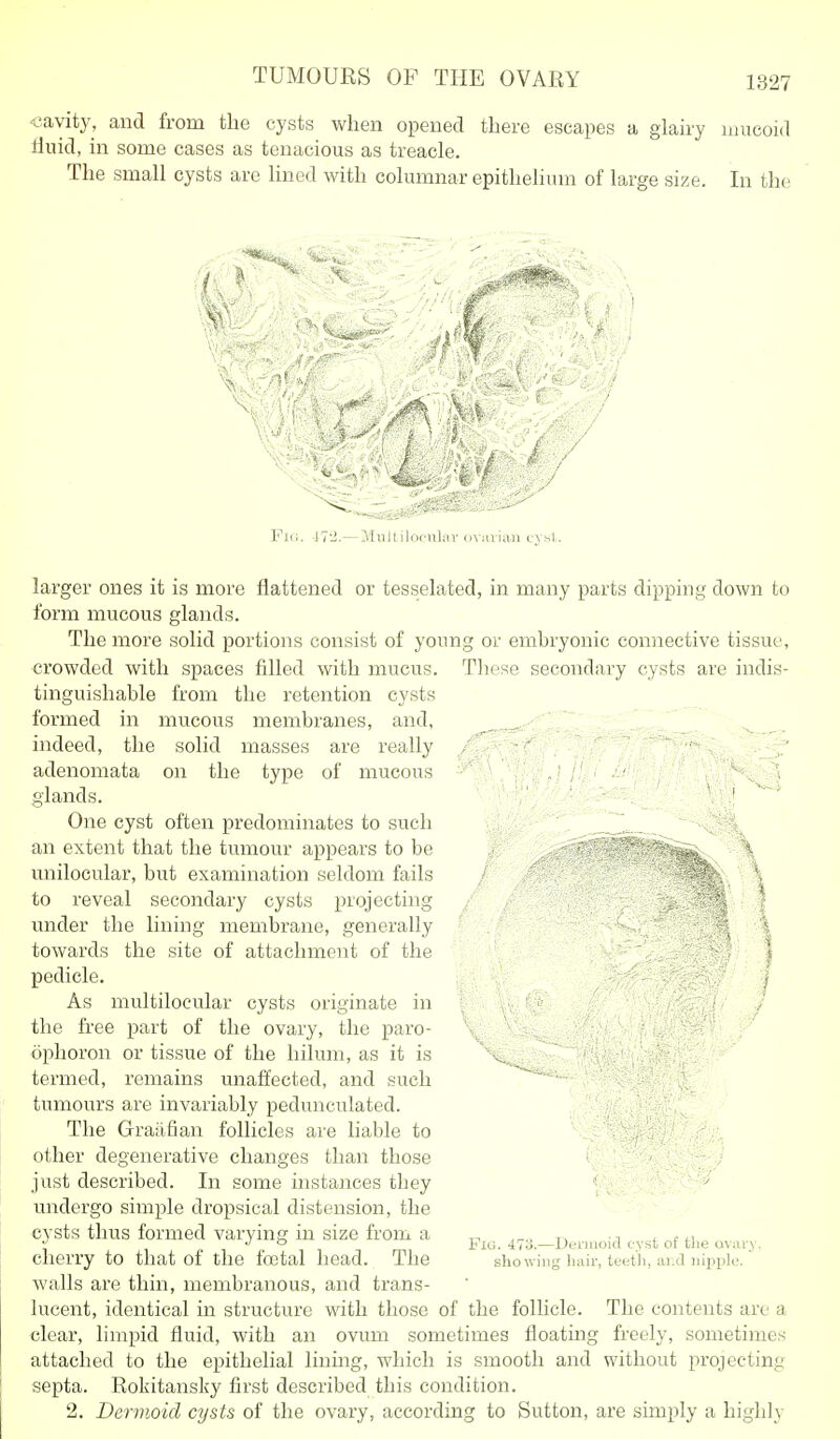 cavity, and from the cysts when opened there escapes a glairy unicoid lluid, in some cases as tenacious as treacle. The small cysts are lined with columnar epithelimn of large size. In the \ Fk;. J7;i.—Mnltilociilar dViuian cysl. larger ones it is more flattened or tesselated, in many parts dipping down to form mucous glands. The more solid portions consist of young or embryonic connective tissue, crowded with spaces filled with mucus. These secondary cysts are indis- tinguishable from the retention cysts formed in mucous membranes, and, „ indeed, the solid masses are really adenomata on the type of mucous . ; . - s glands. ■ ' ^ One cyst often predominates to such an extent that the tumour appears to be unilocular, but examination seldom fails to reveal secondary cysts projecting under the lining membrane, generally towards the site of attachment of the pedicle. As multilocular cysts originate in ' ,/ the free part of the ovary, the paro- ' ^ ophoron or tissue of the hilum, as it is termed, remains unaffected, and such tumours are invariably pedunculated. The Graiifian follicles are liable to : other degenerative changes than those ( just described. In some instances they - ^ undergo simple dropsical distension, the cysts thus formed varying in size from a „ , , JO Fig. 47o.—JJeiinoul cyst oi tiie ovary. cherry to that of the fojtal head. The showing hair, teeth, ai.d nipple, walls are thin, membranous, and trans- lucent, identical in structure with those of the follicle. The contents are a clear, limpid fluid, with an ovum sometimes floating freely, sometimes attached to the epithelial lining, which is smooth and without projecting septa. Rokitansky first described this condition. 2. Dermoid cysts of the ovary, according to Sutton, are simply a highly