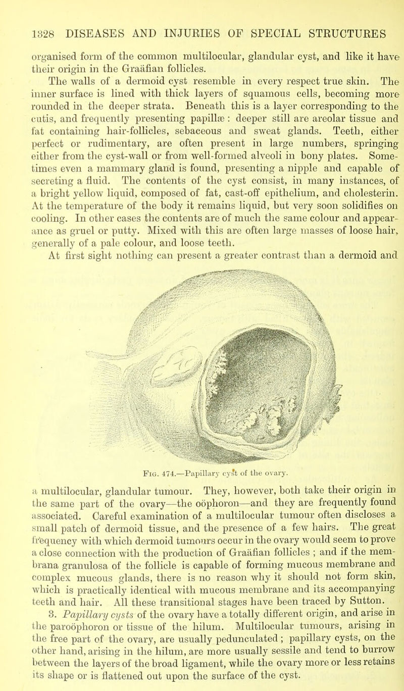 organised form of tlie common multilocular, glandular cyst, and like it have their origin in the Graafian follicles. The walls of a dermoid cyst resemble in every respect true skin. The inner surface is lined with thick layers of squamous cells, becoming more romided in the deeper strata. Beneath this is a layer corresponding to the cutis, and frequently presenting papilliB : deeper still are areolar tissue and fat containing liair-folhcles, sebaceous and sweat glands. Teeth, either perfect or rudimentary, are often present in large numbers, springing either from the cyst-wall or from well-formed alveoli in bony plates. Some- times even a mammary gland is found, presenting a nipple and capable of secreting a fluid. The contents of the cyst consist, in many instances, of a bright yellow liquid, composed of fat, cast-off epithelium, and cliolesterin. At the temperature of the body it remains liquid, but very soon solidifies on cooling. In other cases the contents are of much the same colour and appear- ance as gruel or putty. Mixed with this are often large masses of loose hair, generally of a pale colour, and loose teeth. At first sight nothing can present a greater contrast than a dermoid and a multilocular, glandular tumour. They, however, both take their origin in the same part of the ovary—the oophoron—and they are frequently found associated. Careful examination of a multilocular tumour often discloses a small patch of dermoid tissue, and the presence of a few hairs. The great fr'equency with which dermoid tumours occur in the ovary would seem to prove a close connection with the production of Graafian follicles ; and if the mem- brana granulosa of the follicle is capable of forming mucous membrane and complex mucous glands, there is no reason why it should not form skin, which is practically identical with mucous membrane and its accompanying teeth and hair. All these transitional stages have been traced by Sutton. 3. Papillary cysts of the ovary have a totally different origin, and arise in the paroophoron or tissue of the hilum. Multilocular tumours, arising in the free part of the ovary, are usually pedunculated; papillary cysts, on the other hand, arising in the hilum, are more usually sessile and tend to burrow between the layers of the broad ligament, while the ovary more or less retains its shape or is flattened out upon the surface of the cyst. Fig. 474.—Papillary cyst of the ovary.