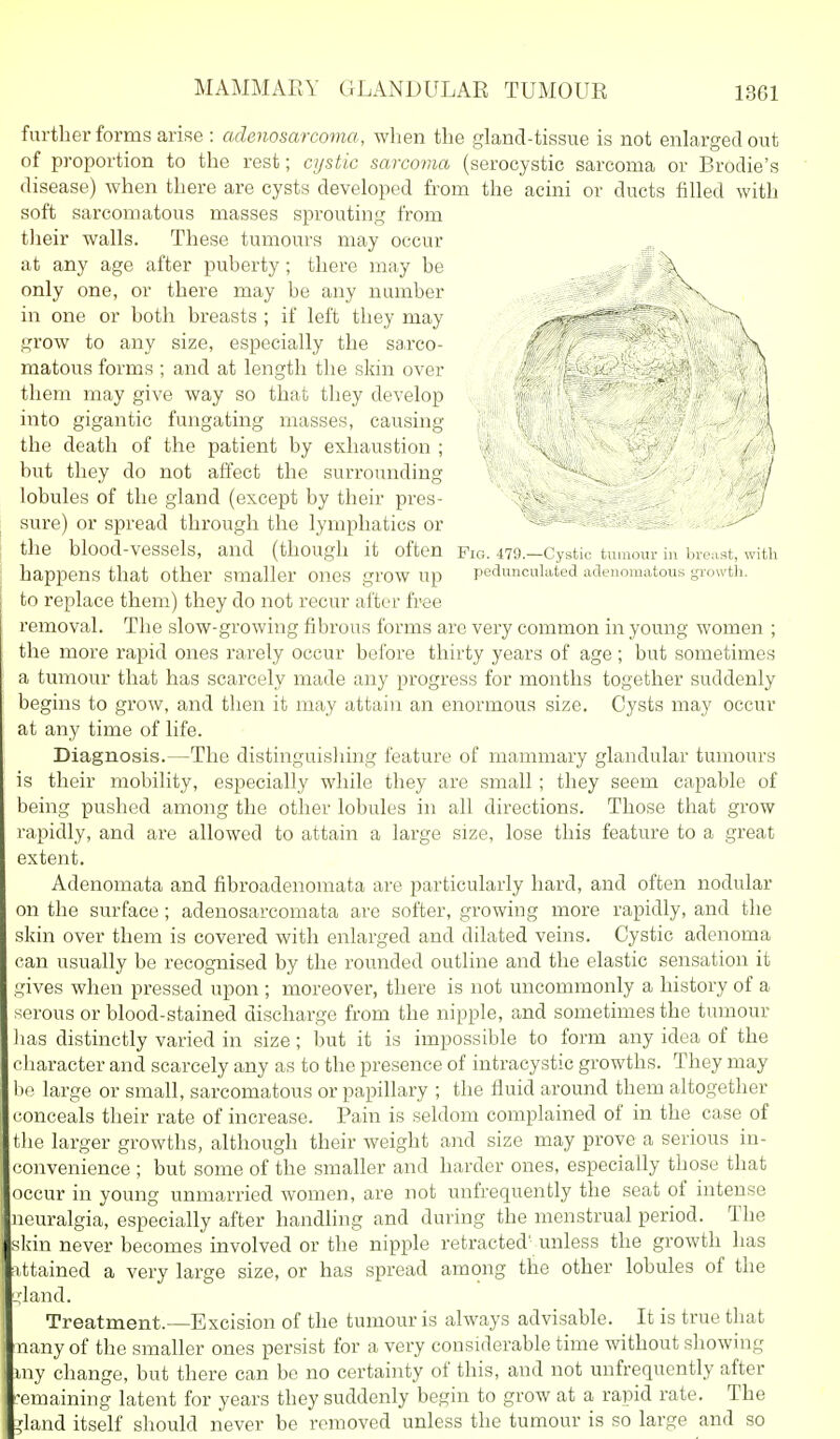 MAMMAEY GLANDULAR TUMOUR further forms arise : adenosarcovia, when the gland-tissue is not enlarged out of proportion to the rest; cystic sarcoma (serocystic sarcoma or Brodie's disease) when there are cysts developed from the acini or ducts filled with soft sarcomatous masses sprouting from their walls. These tumours may occur at any age after puberty; there may be ' \ only one, or there may be any number in one or both breasts ; if left they may ^- v ^ '' grow to any size, especially the sa,rco- matous forms ; and at length the skin over them may give way so that they develop into gigantic fungating masses, causing the death of the patient by exhaustion ; but they do not affect the surrounding lobules of the gland (except by their pres- sure) or spread through the lymphatics or - - --^ the blood-vessels, and (though it often Fig. 479.—Cystic tumour in bi-o.ist, with happens that other smaller ones grow up pedunculated adenomatous growtli. to replace them) they do not recur after free removal. The slow-growing fibrous forms are very common in young women ; the more rapid ones rarely occur before thirty years of age; but sometimes a tumour that has scarcely made any progress for months together suddenly begins to grow, and then it may attain an enormous size. Cysts may occur at any time of life. Diagnosis.—The distinguisliing feature of mammary glandular tumours is their mobility, especially while tliey are small; they seem capable of being pushed among the other lobules in all directions. Those that grow rapidly, and are allowed to attain a large size, lose this feature to a great extent. Adenomata and fibroadenomata are particularly hard, and often nodular on the surface; adenosarcomata are softer, growing more rapidly, and the skin over them is covered with enlarged and dilated veins. Cystic adenoma ;an usually be recognised by the rounded outline and the elastic sensation it gives when pressed upon ; moreover, there is not uncommonly a history of a serous or blood-stained discharge from the nipple, and sometimes the tumour has distinctly varied in size ; but it is impossible to form any idea of the cliaracter and scarcely any as to the presence of intracystic growths. They may i)o large or small, sarcomatous or papillary ; the fluid around them altogether conceals their rate of increase. Pain is seldom complained of in the case of the larger growths, although their weight and size may prove a serious in- convenience ; but some of the smaller and harder ones, especially those that occur in young unmarried women, are not unfrequently the seat of intense neuralgia, especially after handling and during the menstrual period. The skin never becomes involved or the nipple retracted' unless the growth has nttained a very large size, or has spread among the other lobules of the land. Treatment.—Excision of the tumour is always advisable. It is true that nany of the smaller ones persist for a very considerable time without showing my change, but there can be no certainty of this, and not unfrequently after remaining latent for years they suddenly begin to grow at a rapid rate. The jrland itself should never be removed unless the tumour is so large and so