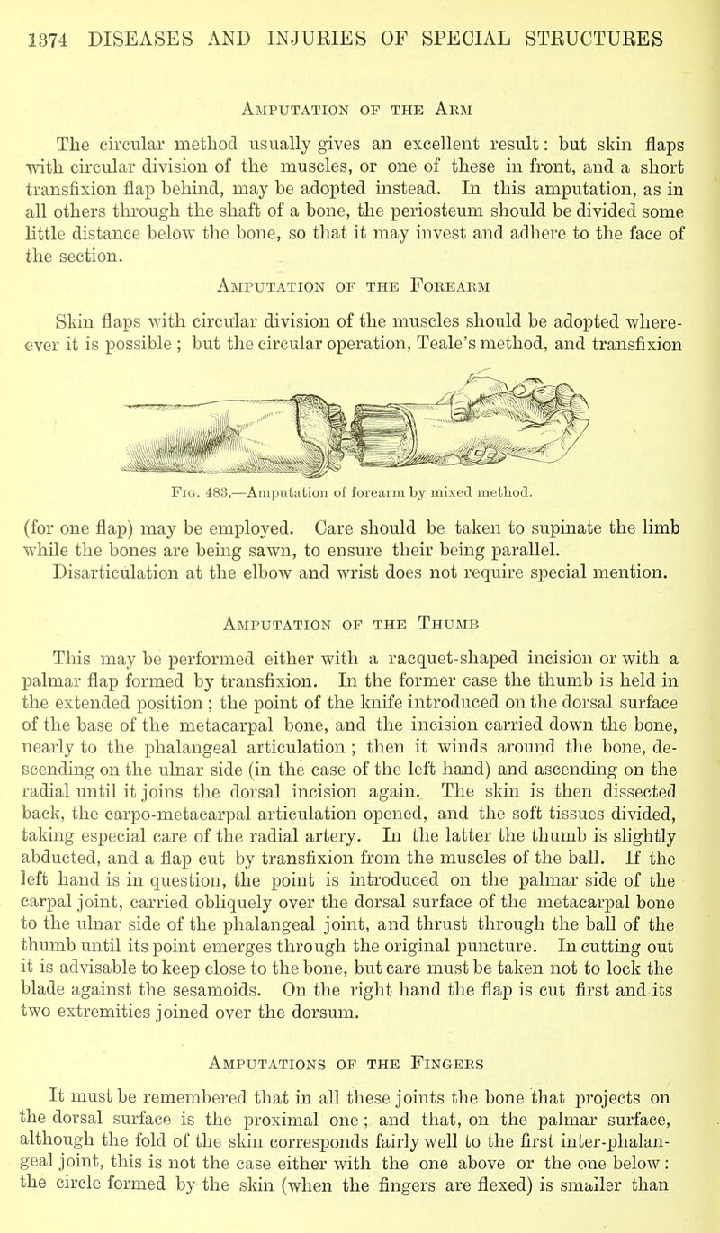 Amputation of the Arm The circular metbod usually gives an excellent result: but skin flaps with circular division of tbe muscles, or one of tbese in front, and a sbort transfixion flap bebind, may be adopted instead. In tbis amputation, as in all otbers tbrougb tbe sbaft of a bone, tbe periosteum sbould be divided some little distance below tbe bone, so tbat it may invest and adhere to tbe face of tbe section. Amputation of the Foeeaem Skin flaps with circular division of tbe muscles sbould be adopted wbere- ever it is possible ; but the circular operation, Teale's metbod, and transfixion Fig. 483.—Amputation of forearm by mixed method. (for one flap) may be employed. Care should be taken to supinate the limb while tbe bones are being sawn, to ensure their being parallel. Disarticulation at the elbow and wrist does not require special mention. Amputation of the Thumb Tbis may be performed either with a racquet-shaped incision or with a palmar flap formed by transfixion. In tbe former case the thumb is held in tbe extended position ; tbe point of the knife introduced on the dorsal surface of the base of the metacarpal bone, and tbe incision carried down the bone, nearly to tbe phalangeal articulation ; then it winds around tbe bone, de- scending on the ulnar side (in the case of the left hand) and ascending on the radial until it joins the dorsal incision again. The skin is then dissected back, the carpo-metacarpal articulation opened, and tbe soft tissues divided, taking especial care of the radial artery. In the latter the thumb is slightly abducted, and a flap cut by transfixion from the muscles of the ball. If the left band is in question, tbe point is introduced on the palmar side of the carpal joint, carried obliquely over tbe dorsal surface of the metacarpal bone to the ulnar side of tbe phalangeal joint, and thrust through the ball of tbe thumb until its point emerges through the original puncture. In cutting out it is advisable to keep close to the bone, but care must be taken not to lock tbe blade against the sesamoids. On the right hand tbe flap is cut first and its two extremities joined over the dorsum. Amputations of the Fingers It must be remembered that in all these joints tbe bone that projects on tbe dorsal surface is tbe proximal one; and tbat, on the palmar surface, although tbe fold of the skin corresponds fairly well to the first inter-pbalan- geal joint, this is not the case either with the one above or the one below: the circle formed by tbe skin (when the fingers are flexed) is smaller than