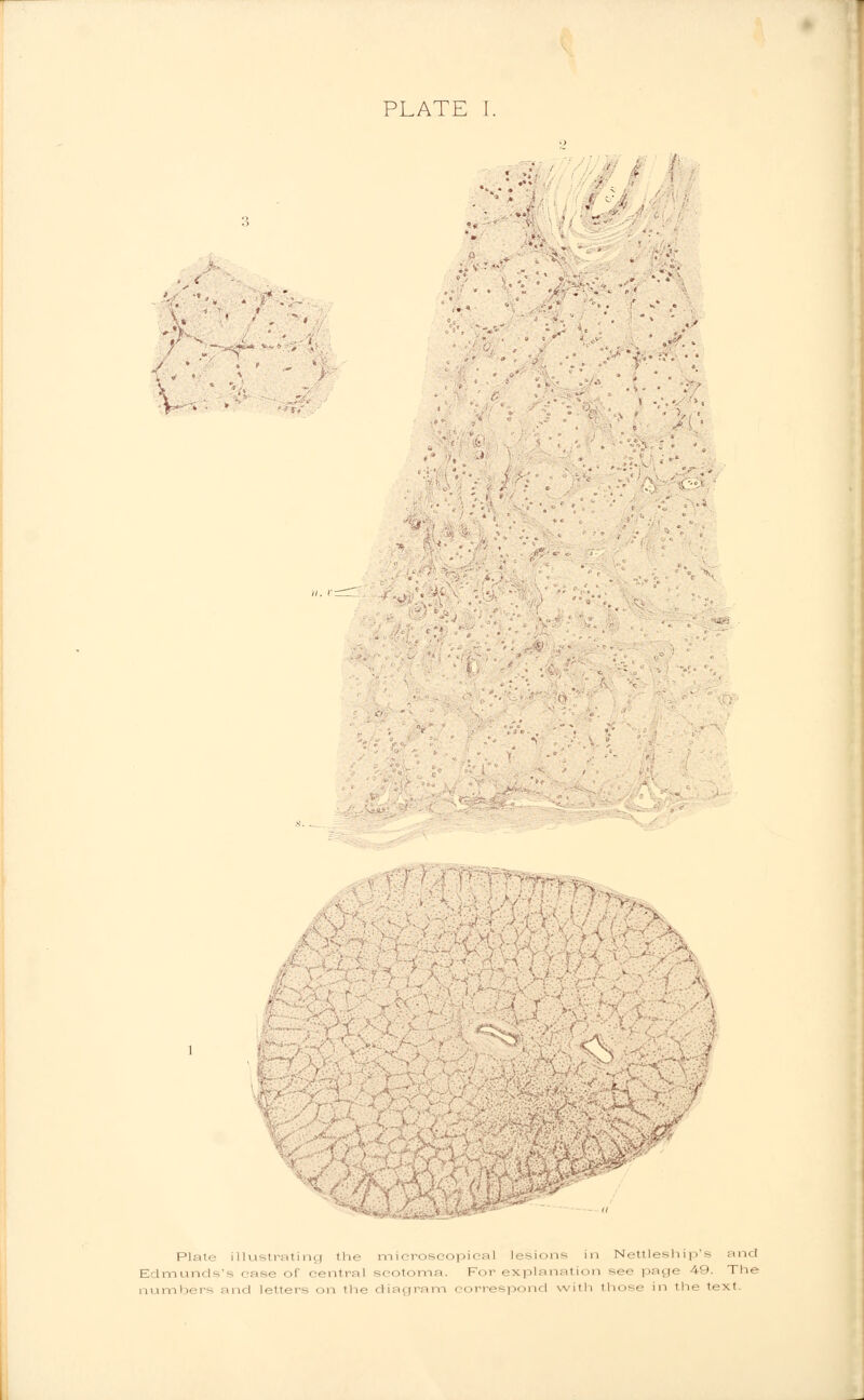 / . \ Plato illustrating (he microscopical lesions in Nettleship's and Edmunds's ease of central scotoma. For explanation see page 49. The numbers and letters on the diagram < orrespond with those in the text.