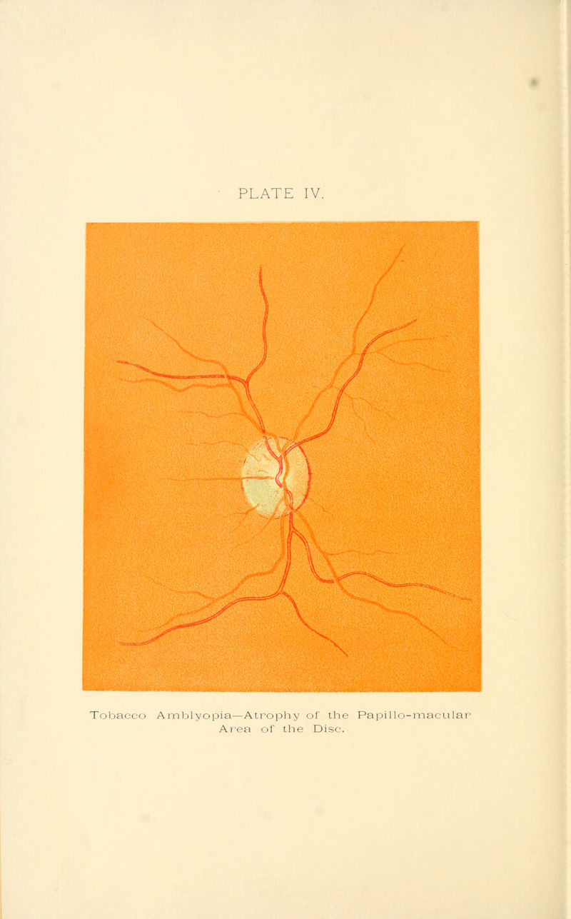 PLATE IV. Tobacco Amblyopia—Atrophy of the Papillo-maeular Area of the Disc.