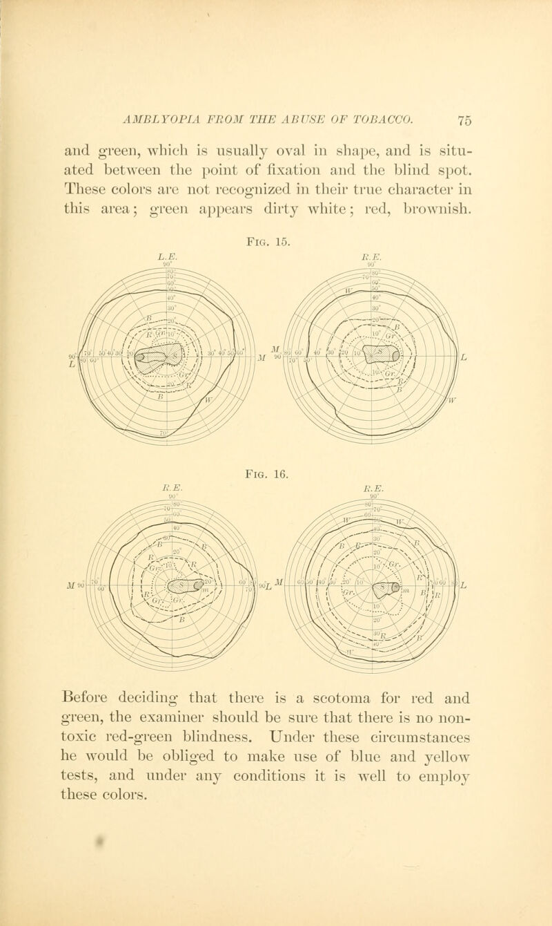 and green, which is usually oval in shape, and is situ- ated between the point of fixation and the blind spot. These colors are not recognized in their true character in this area; green appears dirty white; red, brownish. Fig. 15. Fig. 16. M 90 R. E. Before deciding that there is a scotoma for red and green, the examiner should be sure that there is no non- toxic red-green blindness. Under these circumstances he would be obliged to make use of blue and yellow tests, and under any conditions it is well to employ these colors.