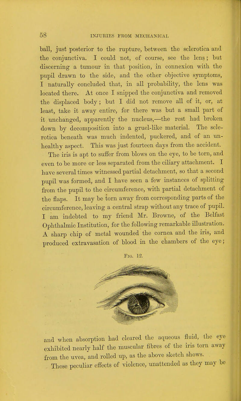 ball, just posterior to the rupture, between the sclerotica and the conjunctiva. I could not, of course, see the lens; but discerning a tumour in that position, in connexion with the pupil drawn to the side, and the other objective symptoms, I naturally concluded that, in all probability, the lens was located there. At once I snipped the conjunctiva and removed the displaced body; but I did not remove all of it, or, at least, take it away entire, for there was but a small part of it unchanged, apparently the nucleus,—the rest had broken down by decomposition into a gruel-like material. The scle- rotica beneath was much indented, puckered, and of an un- healthy aspect. This was just fourteen days from the accident. The iris is apt to suffer from blows on the eye, to be torn, and even to be more or less separated from the ciliary attachment. I have several times witnessed partial detachment, so that a second pupil was formed, and I have seen a few instances of splitting from the pupil to the circumference, with partial detachment of the flaps. It may be torn away from corresponding parts of the circumference, leaving a central strap without any trace of pupil. I am indebted to my friend Mr. Browne, of the Belfast Ophthalmic Institution, for the following remarkable illustration. A sharp chip of metal wounded the cornea and the iris, and produced extravasation of blood in the chambers of the eye; Pig. 12. and when absorption had cleared the aqueous fluid, the eye exhibited nearly half the muscular fibres of the iris torn away from the uvea, and rolled up, as the above sketch shows. These peculiar effects of violence, unattended as they may be