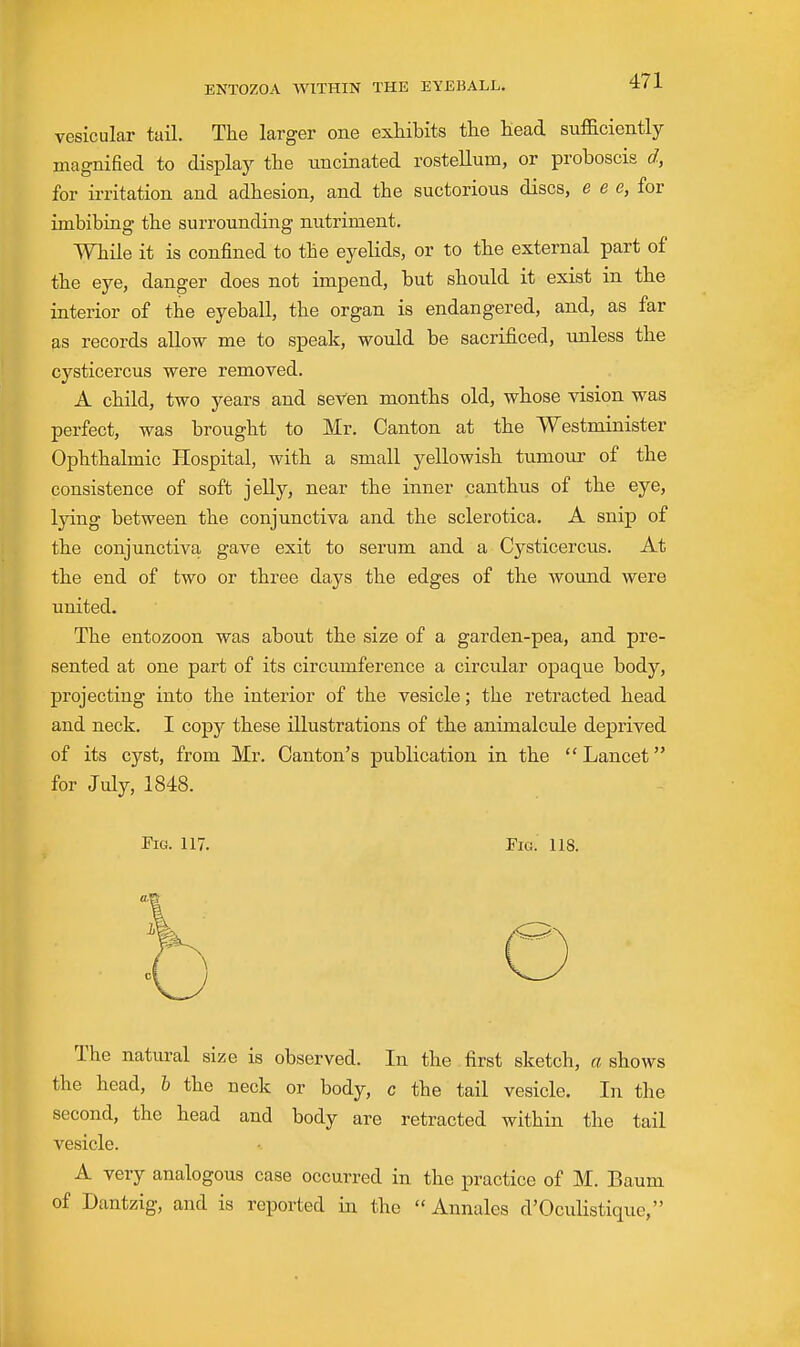 vesicular tail. The larger one exhibits the head sufficiently magnified to display the uncinated rostellum, or proboscis d, for irritation and adhesion, and the suctorious discs, e e e, for imbibing the surrounding nutriment. While it is confined to the eyelids, or to the external part of the eye, danger does not impend, but should it exist in the interior of the eyeball, the organ is endangered, and, as far as records allow me to speak, would be sacrificed, unless the cysticercus were removed. A child, two years and seven months old, whose vision was perfect, was brought to Mr. Canton at the Westminister Ophthalmic Hospital, with a small yellowish tumour of the consistence of soft jelly, near the inner canthus of the eye, lying between the conjunctiva and the sclerotica. A snip of the conjunctiva gave exit to serum and a Cysticercus. At the end of two or three days the edges of the wound were united. The entozoon was about th.e size of a garden-pea, and pre- sented at one part of its circumference a circular opaque body, projecting into the interior of the vesicle; the retracted head and neck. I copy these illustrations of the animalcule deprived of its cyst, from Mr. Canton's publication in the Lancet for July, 1848. Fig. 117. Fic. 118. The natural size is observed. In the first sketch, a shows the head, h the neck or body, c the tail vesicle. In the second, the head and body are retracted within the tail vesicle. A very analogous case occurred in the practice of M. Baum of Dantzig, and is reported in the  Annales d'Oculistique,