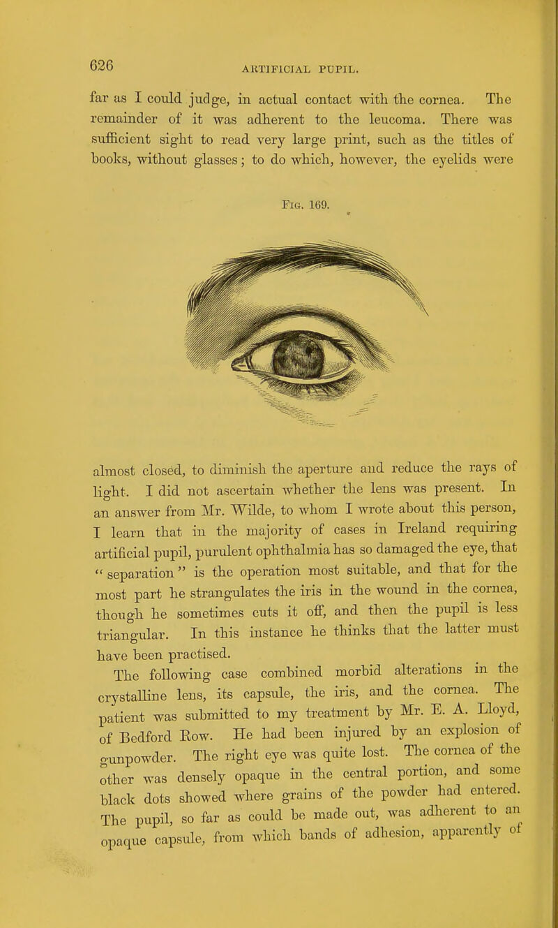 ARTIFICIAL PUPIL. far as I could judge, in actual contact with the cornea. The remainder of it was adherent to the leucoma. There was sufficient sight to read very large print, such as the titles of books, without glasses; to do which, however, the eyelids were Fig. 169. almost closed, to diminish the aperture and reduce the rays of lio-ht. I did not ascertain whether the lens was present. In an answer from Mr. Wilde, to w^hom I wrote about this person, I learn that in the majority of cases in Ireland requiring artificial pupil, purulent ophthalmia has so damaged the eye, that  separation is the operation most suitable, and that for the most part he strangulates the iris in the wound in the cornea, though he sometimes cuts it off, and then the pupil is less triangular. In this instance he thinks that the latter must have been practised. The following case combined morbid alterations in the crjrstaUine lens, its capsule, the iris, and the cornea. The patient was submitted to my treatment by Mr. E. A. Lloyd, of Bedford Eow. He had been injured by an explosion of o-unpowder. The right eye was quite lost. The cornea of the other was densely opaque in the central portion, and some black dots showed where grains of the powder had entered. The pupil, so far as could be made out, was adherent to an opaque capsule, from which bands of adhesion, apparently oi