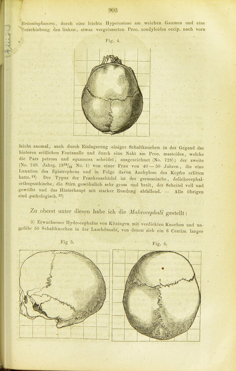 Brünninghaunen, durch eine leichte Hyperostose am weichen Gaumen und eine ^/erschiebiuig des linken, etwas vergrösserten Proc. condyloides occip. nach vorn Fig.. 4. leicht anomal, auch durch Einlagerung einiger Schaltknochen in der Gegend der hinteren seitlichen Fontanelle und durch eine Naht am Proc. mastoides, welche die Pars petrosa und squamosa scheidet; ausgezeichnet (No. 728); der zweite (No. 749. Jahrg. IS^Vas No. 1) von einer Frau von 40 — 50 Jahren, die eine Luxation des Epistropheus und in Folge davon Anchylose des Kopfes erlitten hatte. 11) Der Typus der Frankenschädel ist der germanische, dolichocephal- orthognathische, die Stirn gewöhnlich sehr gross und breit, der Scheitel voll und gewölbt und das Hinterhaupt mit starker Rundung abfallend. — Alle übrigen sind pathologisch, i^) Zu oberst unter diesen habe ich die MahrocephaK gestellt: 3) Erwachsener Hydrocephalus von Kitzingen mit verdickten Knochen und un- gefähr 50 Schaltknochen in der Lambdanaht, von denen sich ein 6 Centim. langer