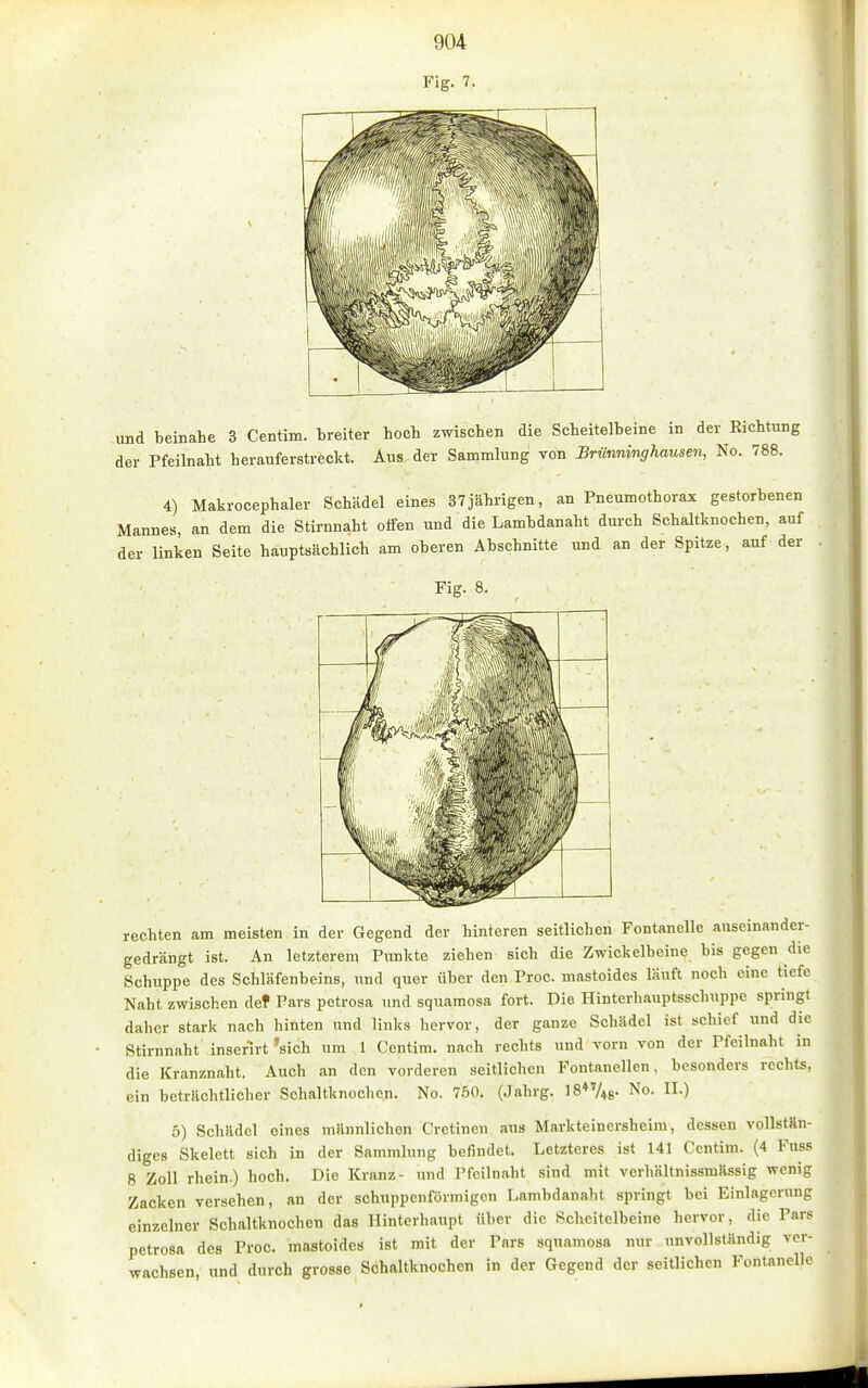 und beinahe 3 Centim. treiter hoch zwischen die Scheitelbeine in der Richtung der Pfeilnaht herauferstreckt. Aus, der Sammlung von Brünninghausen, No. 788. 4) Makrocephaler Schädel eines 37jährigen, an Pneumothorax gestorbenen Mannes, an dem die Stirnnaht offen und die Lambdanaht durch Schaltknochen, auf der linken Seite hauptsächlich am oberen Abschnitte und an der Spitze, auf der Fig. 8. rechten am meisten in der Gegend der hinteren seitlichen Fontanelle auseinander- gedrängt ist. An letzterem Punkte ziehen sich die Zwickelbeine bis gegen die Schuppe des Schläfenbeins, und quer über den Proc. mastoides läuft noch eine tiefe Naht zwischen def Pars petrosa imd squamosa fort. Die Hinterhauptsschuppe springt daher stark nach hinten und links hervor, der ganze Schädel ist schief und die Stirnnaht inserlrt 'sich um 1 Centim. nach rechts und vorn von der Pfcilnaht in die Kranznaht. Auch an den vorderen seitlichen Fontanellen, besonders rechts, ein beträchtlicher Schaltknochen. No. 7.50. (Jahrg. IS^V«- No. II.) 5) Schädel eines männlichen Cretinen aus Markteinersbeira, dessen vollstän- diges Skelett sich in der Sammlung befindet. Letzteres ist 141 Centim. (4 Fuss 8 Zoll rhein.) hoch. Die Kranz- und rfcilnaht sind mit verhältnissmässig wenig Zacken versehen, an der schuppcnförmigcn Lambdanaht springt bei Einlagerung einzelner Schaltknochen das Hinterhaupt über die Scheitelbeine hervor, die Pars petrosa des Proc. mastoides ist mit der Pars squamosa nur unvollständig ver- wachsen, und durch grosse Schaltknochen in der Gegend der seitlichen Fontanelle