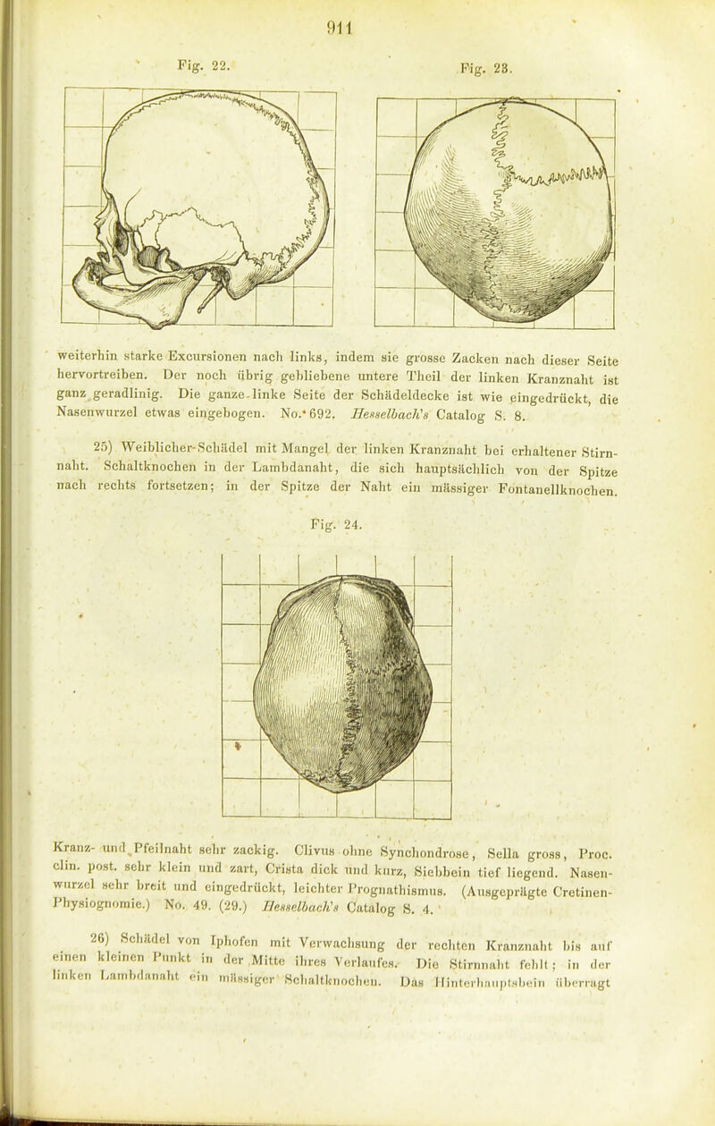 Fig. 22. Fig. 28. weiterhin starke Excursionen nach links, indem sie grosse Zacken nach dieser Seite hervortreihen. Der noch übrig gebliebene untere Theil der linken Kranznaht ist ganz geradlinig. Die ganze-linke Seite der Schildeldecke ist wie eingedrückt die Nasenwurzel etwas eingebogen. No.'692. HesselhaclCs Catalog S. 8. 25) Weiblicher-Schädel mit Mangel der linken Kranznalit bei erhaltener Stirn- naht. Schaltknochen in der Lambdanaht, die sich hauptsächlich von der Spitze nach rechts fortsetzen; in der Spitze der Naht ein massiger Fontanellknochen. Fig. 24. Kranz- und. Pfeilnaht sehr zackig. Clivus olinc Synchondro.se, Sella gross, Proc. Clin. post. sehr klein und zart, Crista dick und kurz, Siebbein tief liegend. Nasen- wurzel sehr breit und eingedrückt, leichter Prognathismus. (Au,sgcprägte Cretinen- Physiognomie.) No. 49. (29.) EeaaelhacKa Catalog S. 4. 26) Sclüidel von Iphofen mit Verwachsung der recliten Kranznaht ])is auf einen kleinen Punkt in der Mitte ihres Verlaufes. Die Stirnnaht fehlt; in der linken Lambdanaht ein mKssigcr Scbaltknochen. Da« innte,l.,,Mpf..bein ilb.-nagt