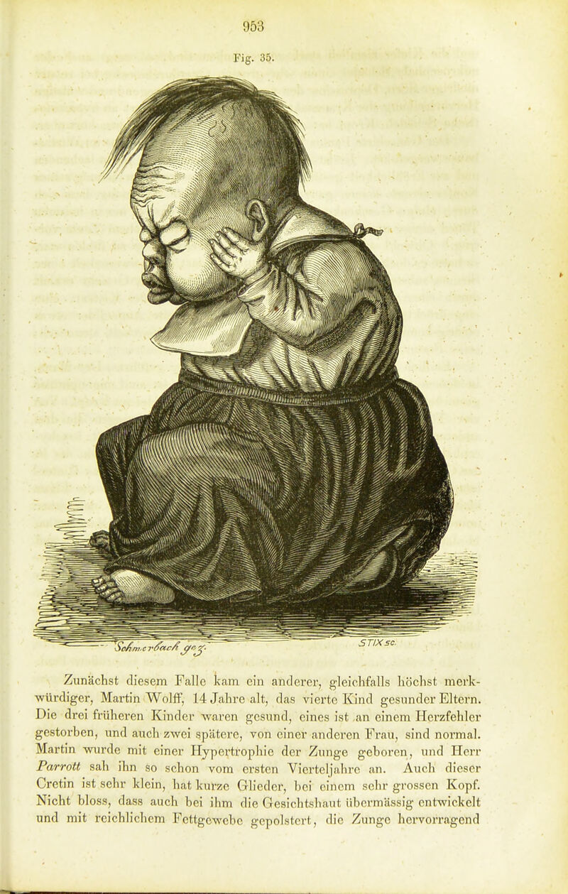Fig. 35. Zunächst diesem Ftallc kam ein anderer, gleichfalls höchst merk- würdiger, Martin Wolff, 14 Jahre alt, das vierte Kind gesunder Eltern. Die drei früheren Kinder waren gesund, eines ist an einem Herzfehler gestorben, und auch zwei spätere, von einer anderen Frau, sind normal. Martin wurde mit einer Hypertrophie der Zunge geboren, und Herr Parrott sah ihn so schon vom ersten Vierteljahre an. Auch dieser Crctin ist sehr klein, hat kurze Glieder, bei einem sehr grossen Kopf Nicht bloss, dass auch bei ihm die Gesichtshaut übermässig entwickelt und mit reichlichem Fettgewebe gepolstert, die Zunge hervorragend
