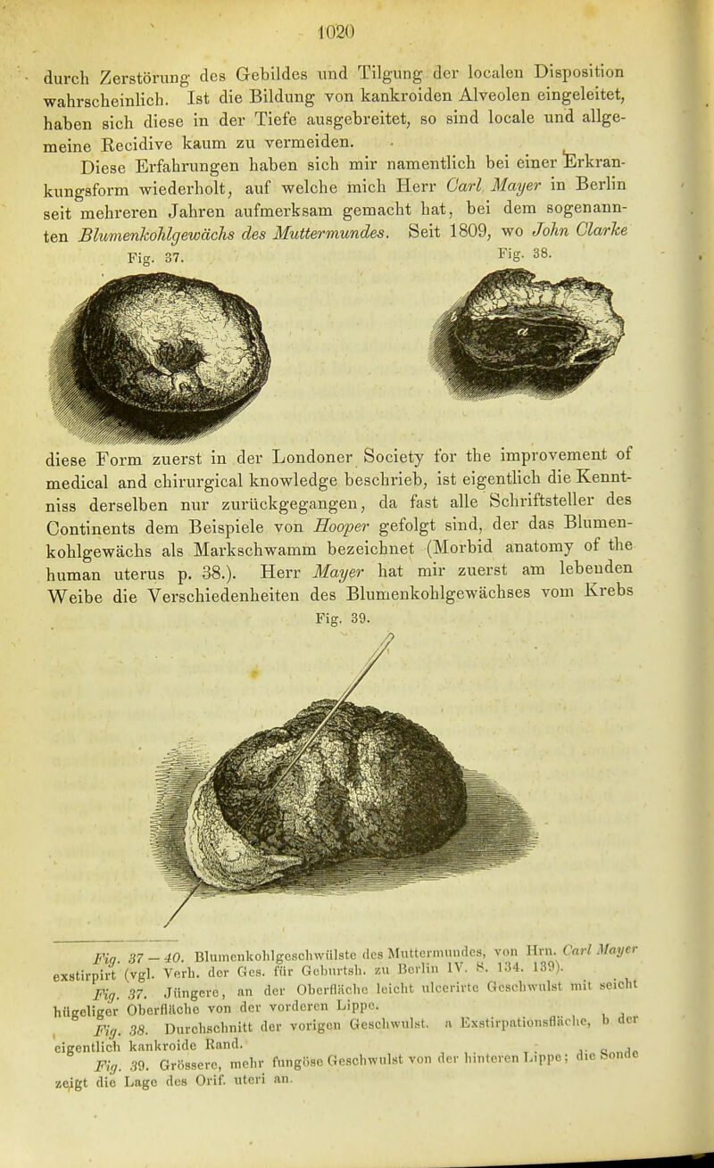 durch Zerstörung des Gebildes und Tilgung der localen Disposition wahrscheinlich. Ist die Bildung von kankroiden Alveolen eingeleitet, haben sich diese in der Tiefe ausgebreitet, so sind locale und allge- meine Recidive kaum zu vermeiden. Diese Erfahrungen haben sich mir namentlich bei einer Erkran- kungsform wiederholt, auf welche mich Herr Garl. Mayer in Berlin seit mehreren Jahren aufmerksam gemacht hat, bei dem sogenann- ten Blumenkohlgewächs des Muttermundes. Seit 1809, wo John Clarke Fis- 37. Fig. 38. diese Form zuerst in der Londoner Society for the improvement of medical and chirurgical knowledge beschrieb, ist eigenthch die Kennt- niss derselben nur zurückgegangen, da fast alle Schriftsteller des Continents dem Beispiele von Hooper gefolgt sind, der das Blumen- kohlgewächs als Markschwamm bezeichnet (Morbid anatomy of the human uterus p. 38.). Herr Mayer hat mir zuerst am lebenden Weibe die Verschiedenheiten des Blumenkohlgewächses vom Krebs Fiff. 39. Pin 37-40. BlumenkohlgeschwiOste des Muttermuudes, von Hrn. Carl Mayer exstirpirt (vgl. Verb, der Ges. für Goburtsh. zu Berlin IV. t*. 134. 139). Fig. 37. Jüngere, an der Oberfläcbc leicbt ulcerirtc Gescbwulst mit seicbt hügeliger Oberflilche von der vorderen Lippe. Fig. 38. DurclLSCbnitt der vorigen Gescl.wul.st. .a Exstirpationsflächc, b der eigentlicb kankroide Rand. j- o ,io Fiff. .39. Grössere, mehr fungöse Geschwulst von der hinteren Lippe; die bonde ze^gt die Lage des Orif. uteri an.