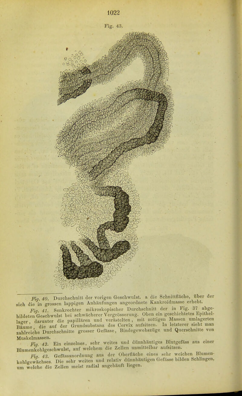 Fig. 43. Fig. 40. Durclischuitt der vorigen Geschwulst, a die Schnittfläche, über der sich die in grossen lappigen Anhäufungen angeordnete Kankroidmasse erhebt. Fiq 41 Senkrechter mikroskopischer Durchschnitt der in Fig. 37 abge- bildeten Geschwulst bei schwächerer Vergrösserung. üben ein geschichtetes Epithel- lacer darunter die papillären und verästelten, mit zottigen Massen umlagerten Bäume die auf der Grundsubstnnz des Cervix aufsitzen. In letzterer sieht man zahlreiche Durchschnitte grosser Gefllsse, Bindegewebszüge und Querschnitte von Muskelmassen. Fig 42 Ein einzelnes, sehr weites und dünnhäutiges Blutgefäss aus einer Blnmenkohlgeschwulst, auf welchem die Zellen unmittelbar aufsitzen. Pin 4.3 Gcfiissanordnung aus der Oberfläche eines sehr weichen Blumen- kohlgewilchses. Die sehr weiten und relativ dünnhäutigen Gef-isse bilden Schlingen, um welche die Zellen meist radial augehäuft hegen.