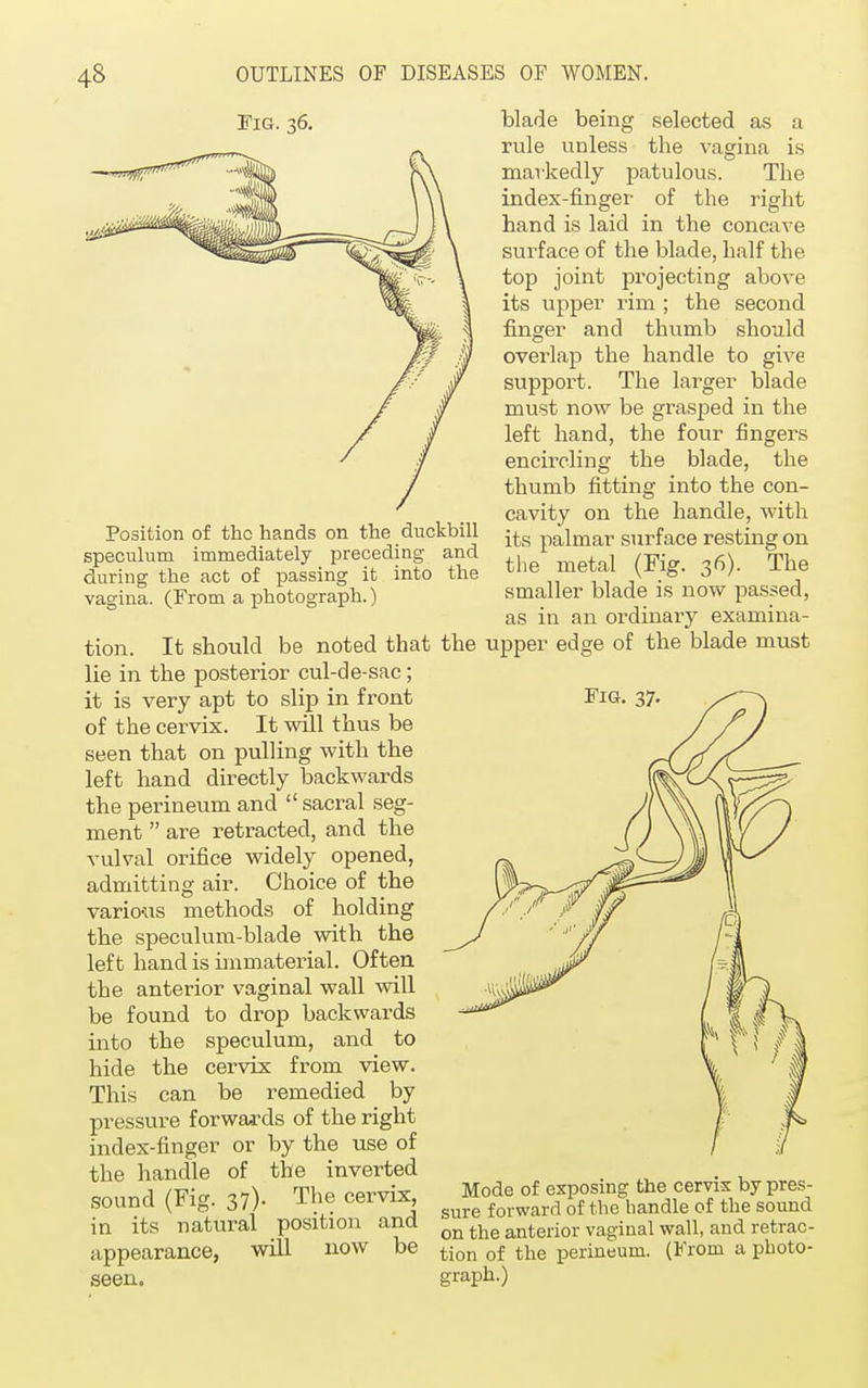Fig. 36. Position of the hands on the duckbill speculum immediately preceding and during the act of passing it into the vagina. (From a photograph.) tion. It should be noted that the upper edge of the blade must lie in the posterior cul-de-sac; blade being selected as a rule unless the vagina is markedly patulous. The index-finger of the right hand is laid in the concave surface of the blade, half the top joint projecting above its upper rim ; the second finger and thumb should overlap the handle to give support. The larger blade must now be grasped in the left hand, the four fingers encircling the blade, the thumb fitting into the con- cavity on the handle, with its palmar surface resting on the metal (Fig. 36). The smaller blade is now passed, as in an ordinary examina- it is very apt to slip in front of the cervix. It will thus be seen that on pulling with the left hand directly backwards the perineum and  sacral seg- ment  are retracted, and the vulval orifice widely opened, admitting air. Choice of the various methods of holding the speculum-blade with the left hand is immaterial. Often the anterior vaginal wall will be found to drop backwards into the speculum, and to hide the cervix from view. This can be remedied by pressure forwards of the right index-finger or by the use of the handle of the inverted sound (Fig. 37). The cervix, in its natural position and appearance, will now be seen. Fig Mode of exposing the cervix by pres- sure forward of the handle of the sound on the anterior vaginal wall, and retrac- tion of the perineum. (From a photo- graph.)