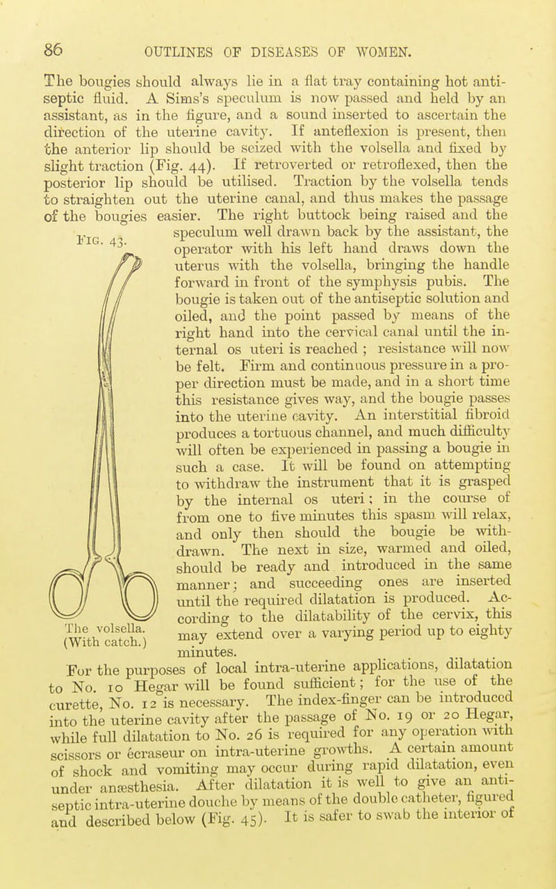 Fig. 43- The bougies should always lie in a flat tray containing hot anti- septic fluid. A Sims's speculum is now passed and held by an assistant, as in the figure, and a sound inserted to ascertain the direction of the uterine cavity. If anteflexion is present, then the anterior lip should be seized with the volsella and fixed by slight traction (Fig. 44). If retroverted or retroflexed, then the posterior lip should be utilised. Traction by the volsella tends to straighten out the uterine canal, and thus makes the passage of the bougies easier. The right buttock being raised and the speculum well drawn back by the assistant, the operator with his left hand draws down the uterus with the volsella, bringing the handle forward in front of the symphysis pubis. The bougie is taken out of the antiseptic solution and oiled, and the point passed by means of the right hand into the cervical canal until the in- ternal os uteri is reached ; resistance will now be felt. Firm and continuous pressure in a pro- per direction must be made, and in a short time this resistance gives way, and the bougie passes into the uterine cavity. An interstitial fibroid produces a tortuous channel, and much difficulty will often be experienced in passing a bougie in such a case. It will be found on attempting to withdraw the instrument that it is grasped by the internal os uteri; in the course of from one to five minutes this spasm will relax, and only then should the bougie be with- drawn. The next in size, warmed and oiled, should be ready and introduced in the same manner; and succeeding ones are inserted until the required dilatation is produced. Ac- cording to the dilatability of the cervix, this may extend over a varying period up to eighty minutes. For the purposes of local intra-uterine applications, dilatation to No 10 Hegar will be found sufficient; for the use of the curette, No. 12 is necessary. The index-finger can be introduced into the uterine cavity after the passage of No. 19 or 20 Hegar, while full dilatation to No. 26 is required for any operation with scissors or 6craseur on intra-uterine growths. A certain amount of shock and vomiting may occur during rapid dilatation, even under anesthesia. After dilatation it is well to give an anti- septic intra-uterine douche by means of the double catheter, figured and described below (Fig. 45)- Ifc is saiev to swab the inten01' °f The volsella. (With catch.)